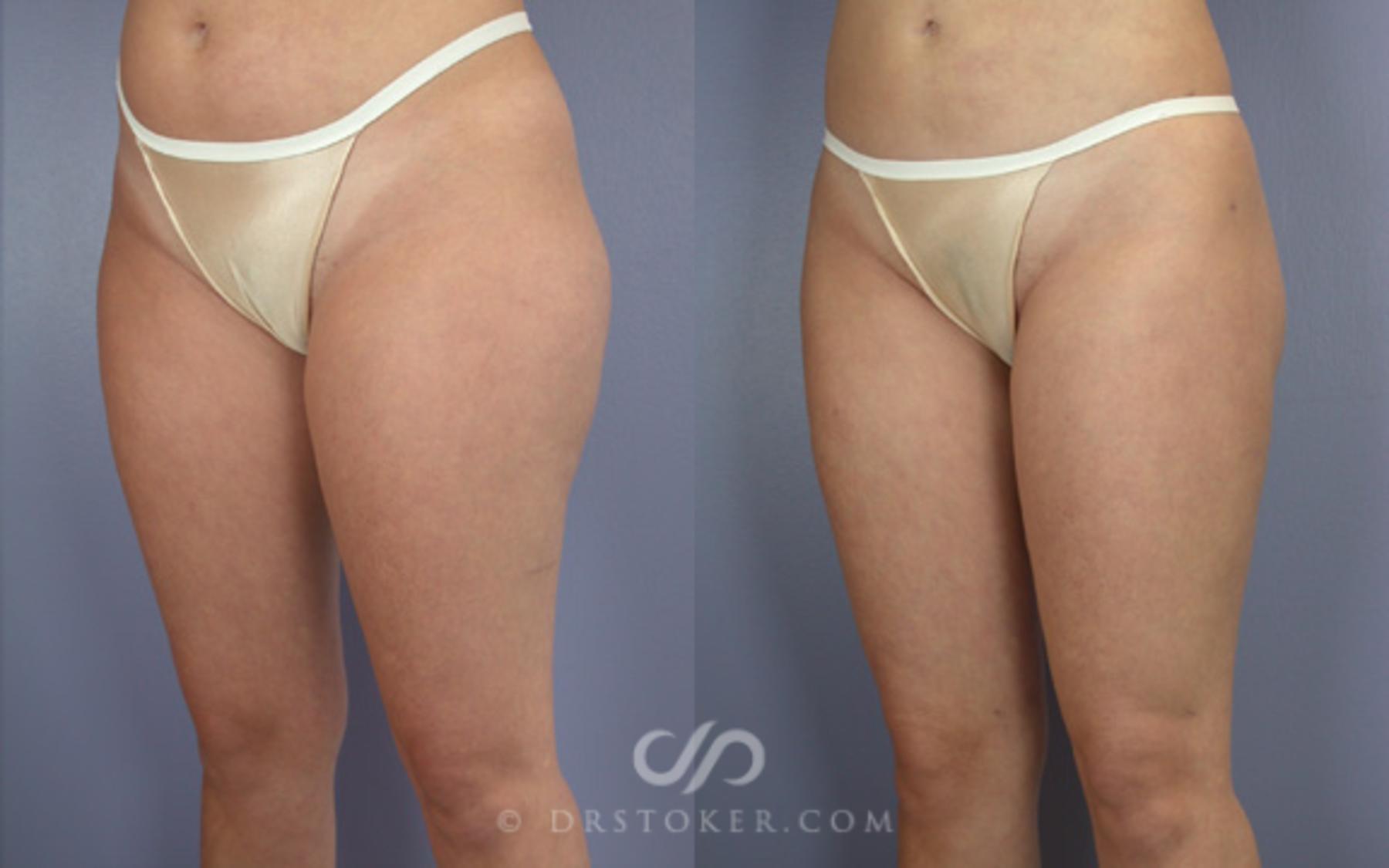Before & After Liposuction Case 19 View #3 View in Los Angeles, CA
