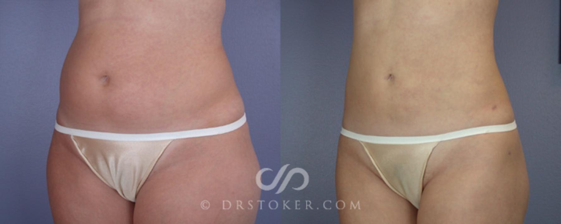 Before & After Liposuction Case 19 View #4 View in Los Angeles, CA