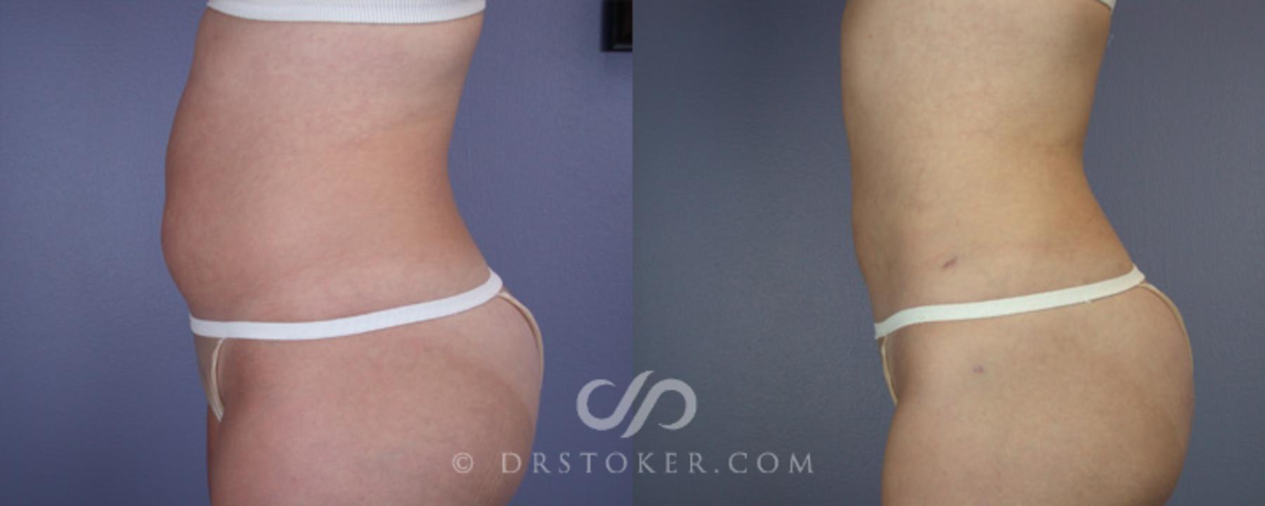 Before & After Liposuction Case 19 View #5 View in Los Angeles, CA