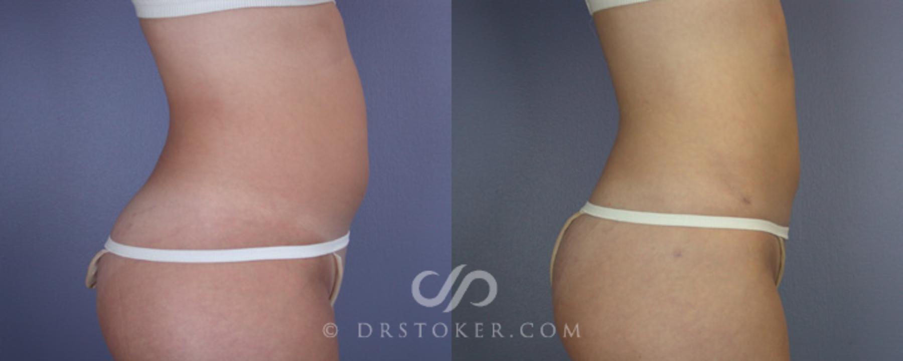 Before & After Liposuction Case 19 View #6 View in Los Angeles, CA