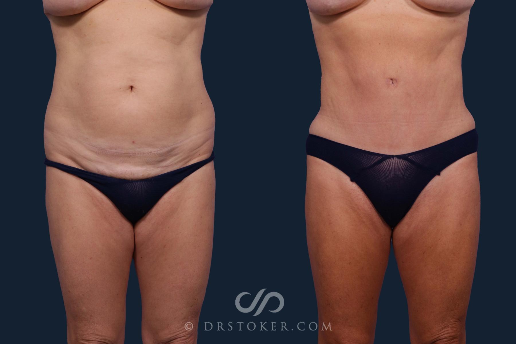 Before & After Liposuction Case 1912 Front View in Los Angeles, CA
