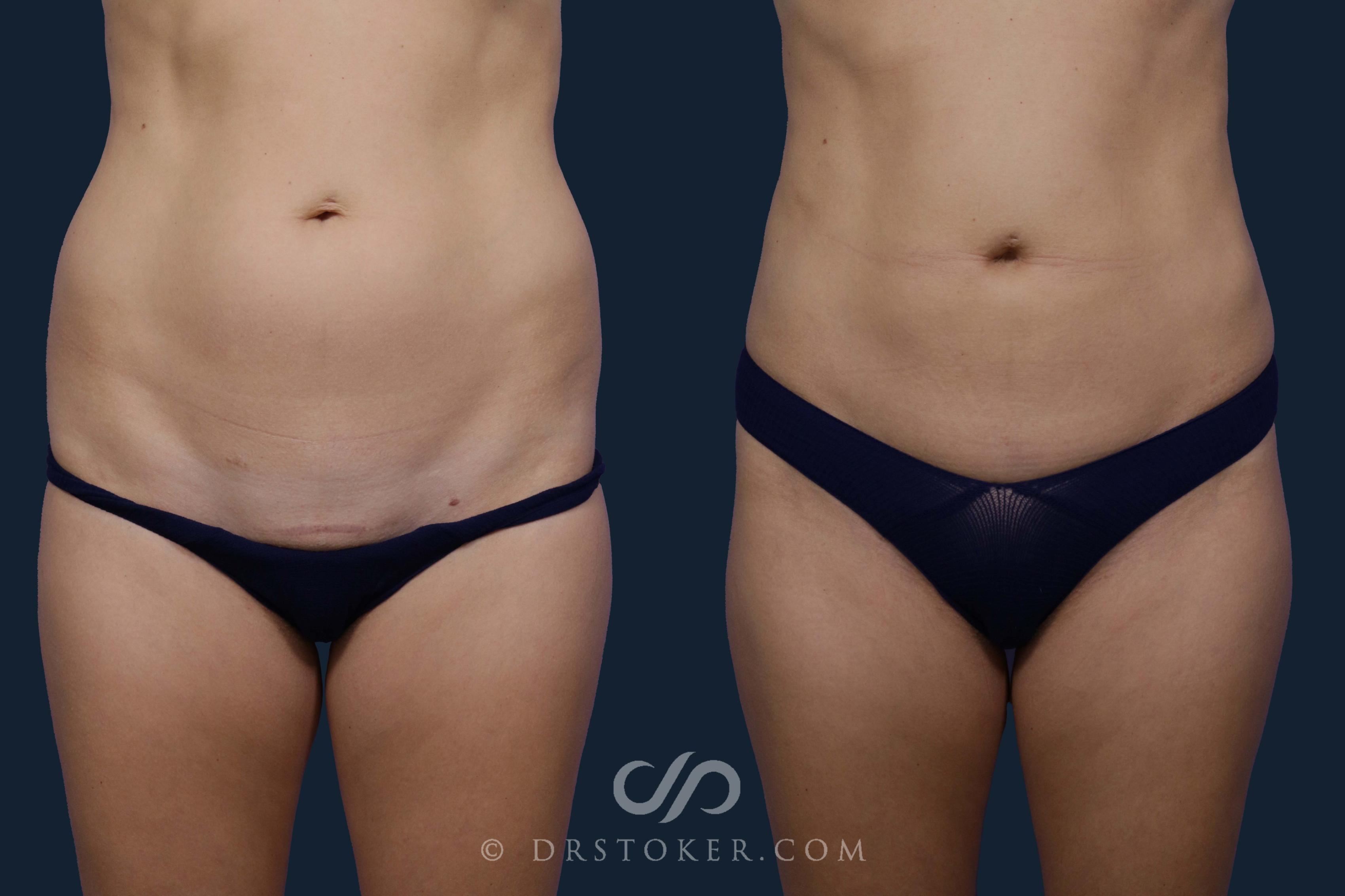 Before & After Liposuction Case 1931 Front View in Los Angeles, CA