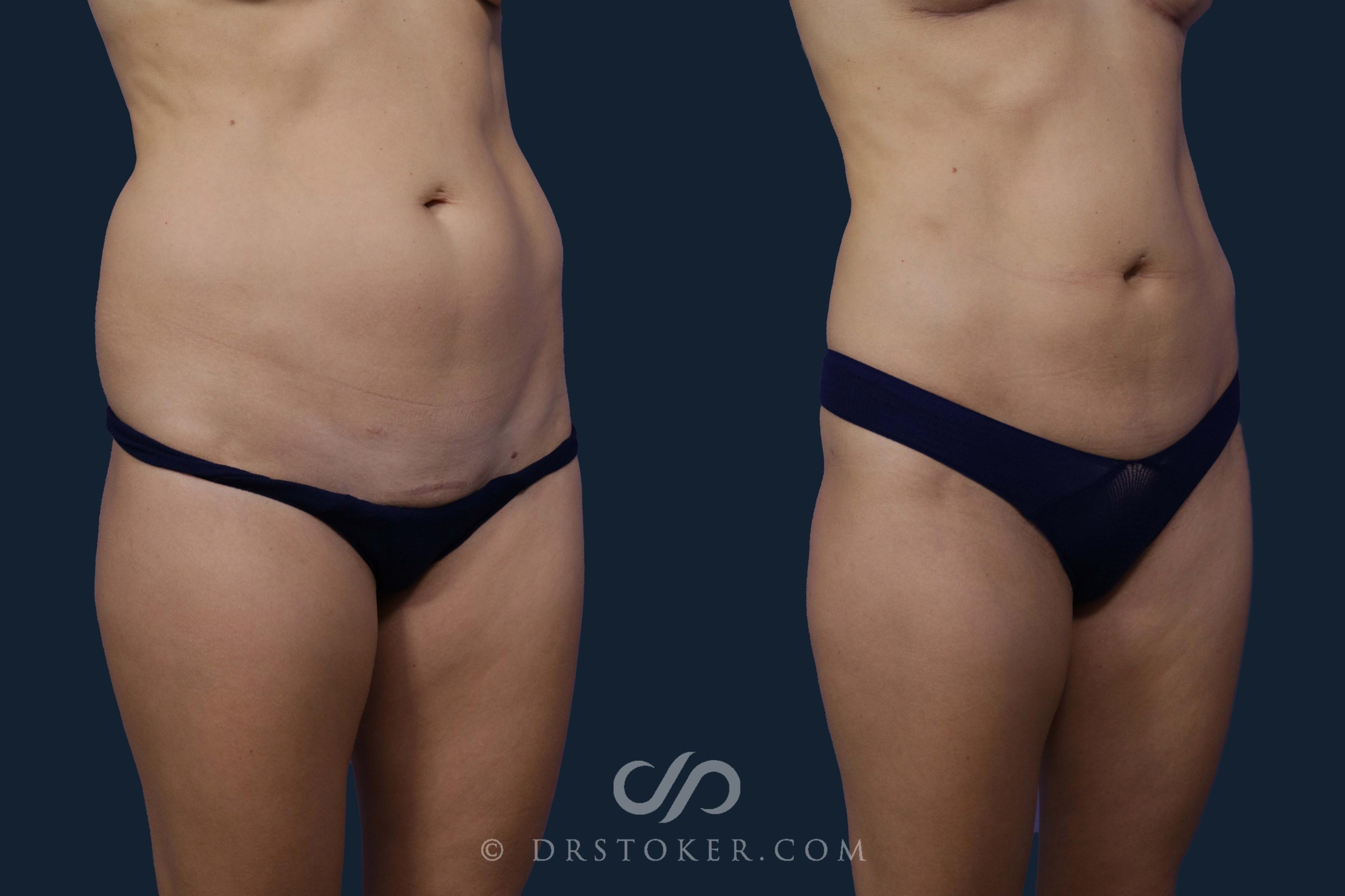 Before & After Liposuction Case 1932 Right Oblique View in Los Angeles, CA