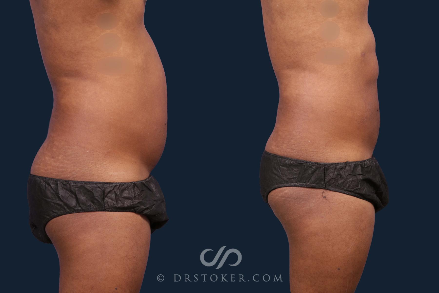 Before & After Liposuction Case 1934 Right Side View in Los Angeles, CA