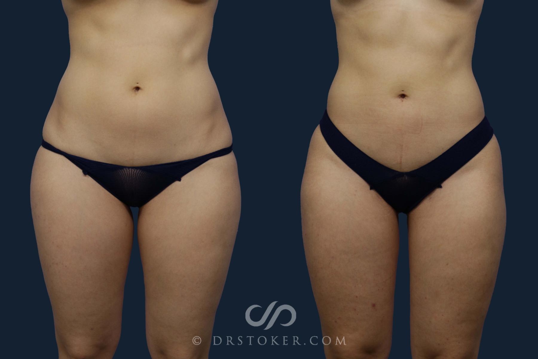 Before & After Liposuction Case 1949 Front View in Los Angeles, CA