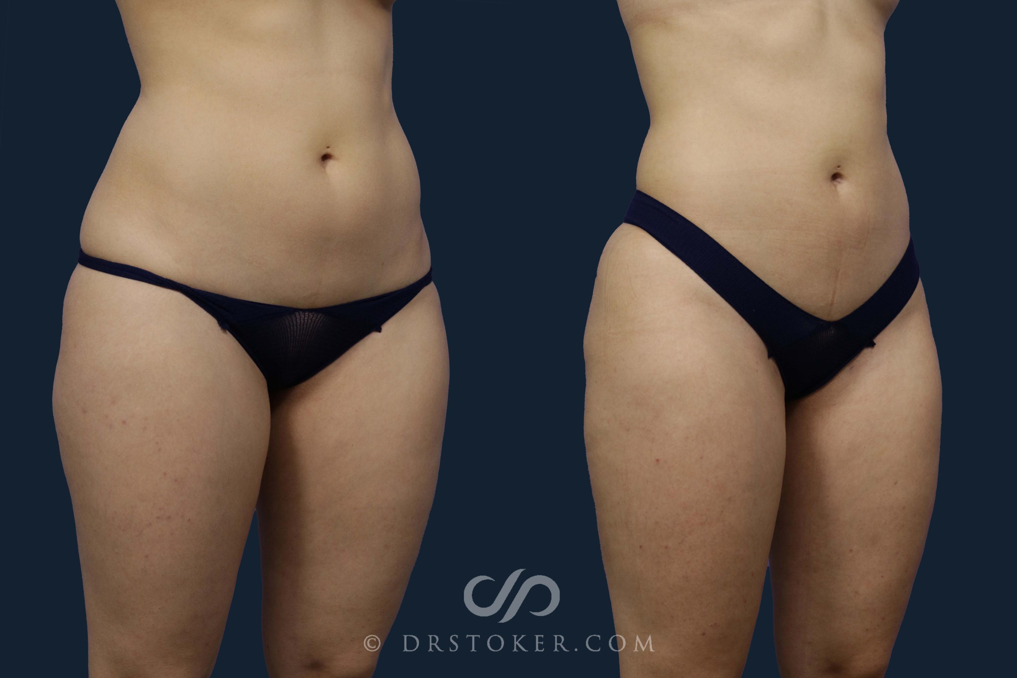 Before & After Liposuction Case 1950 Right Oblique View in Los Angeles, CA