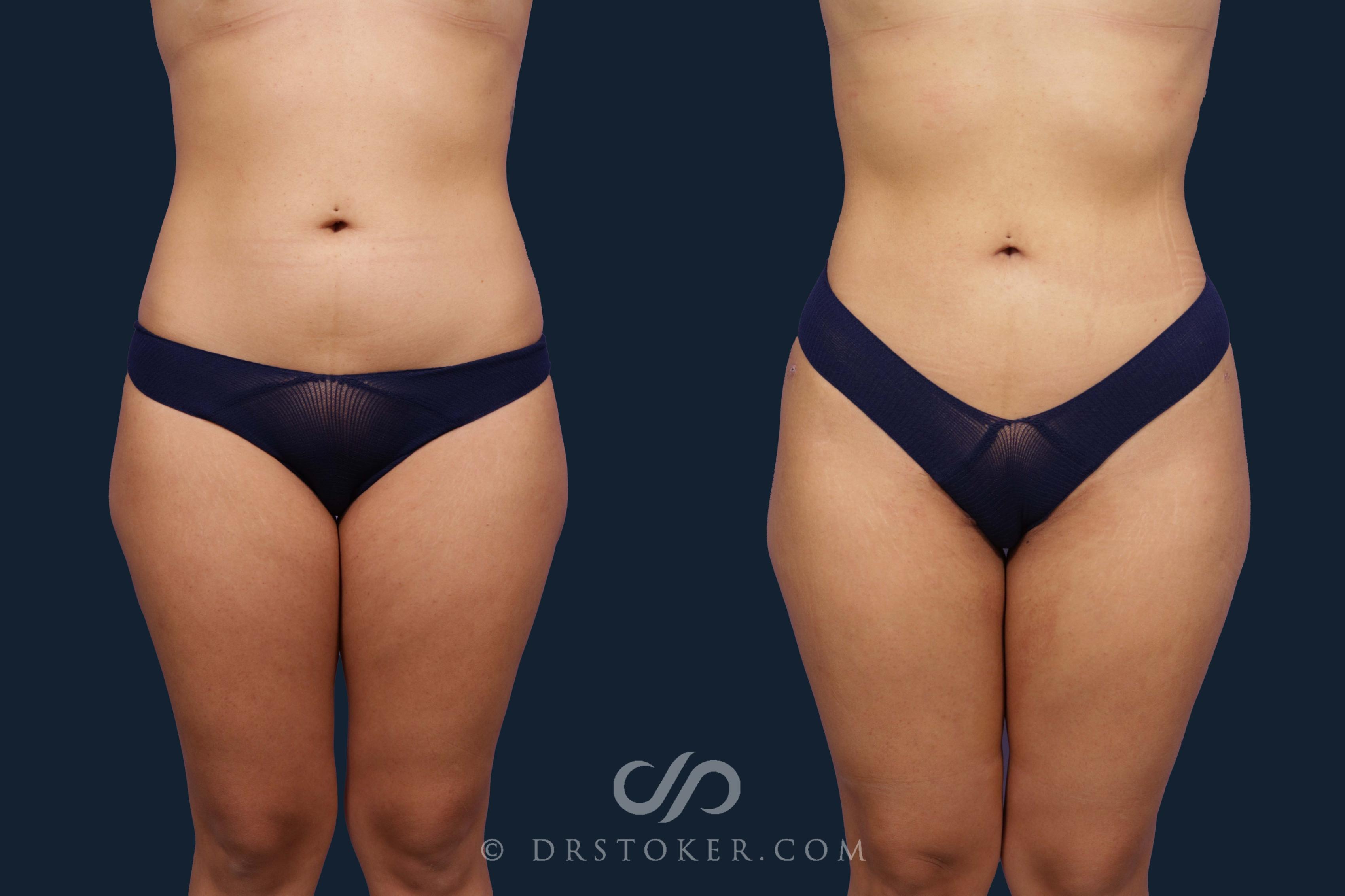Before & After Liposuction Case 1954 Front View in Los Angeles, CA
