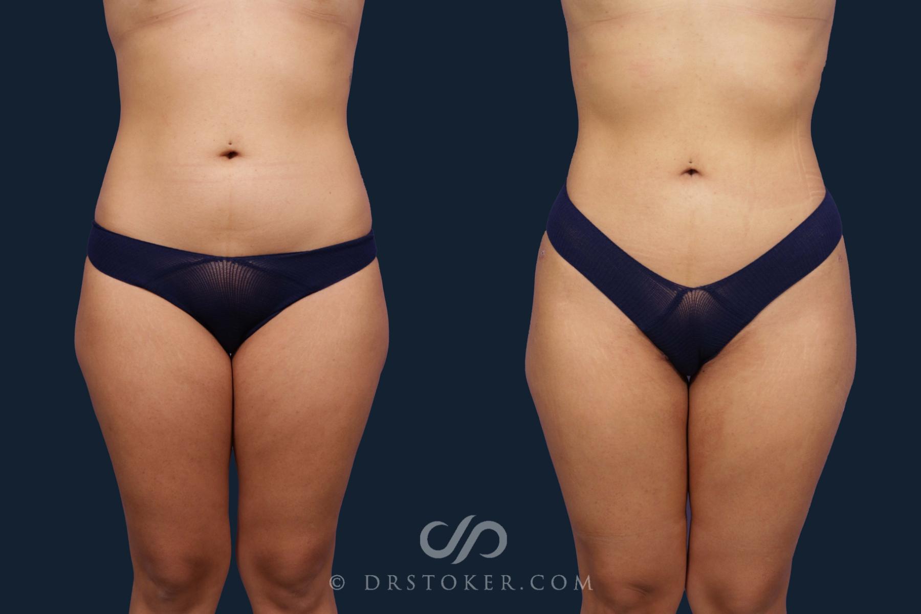 Before & After Liposuction Case 1954 Front View in Los Angeles, CA