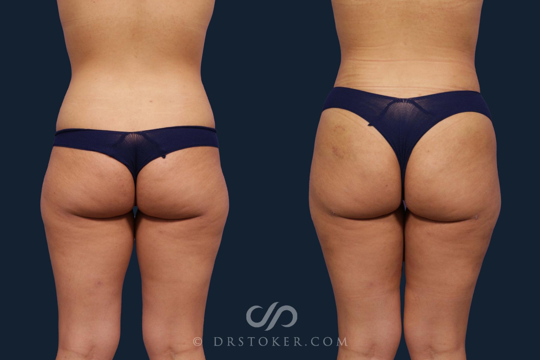Before & After Liposuction Case 1955 Back View in Los Angeles, CA