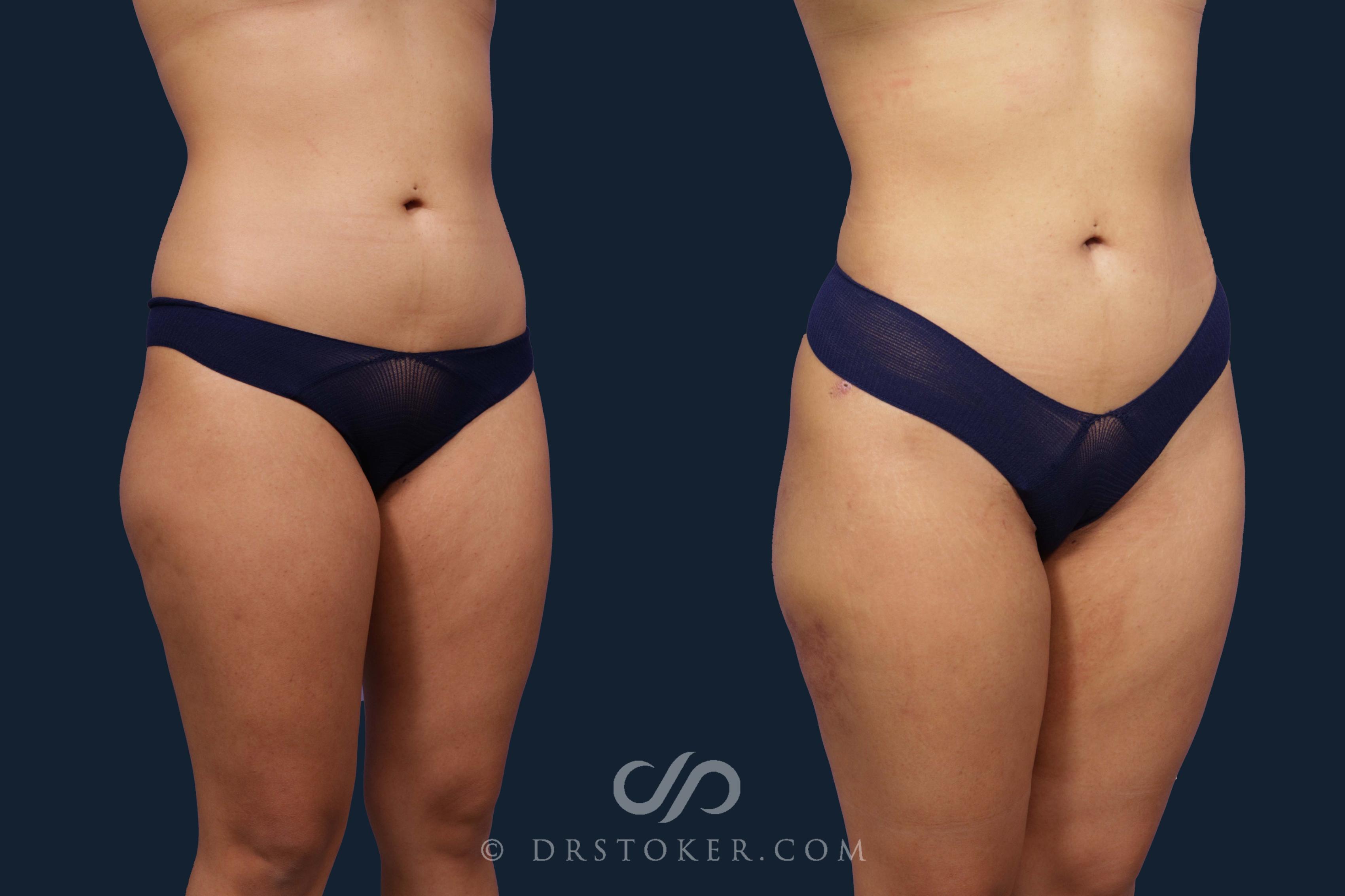 Before & After Liposuction Case 1956 Right Oblique View in Los Angeles, CA