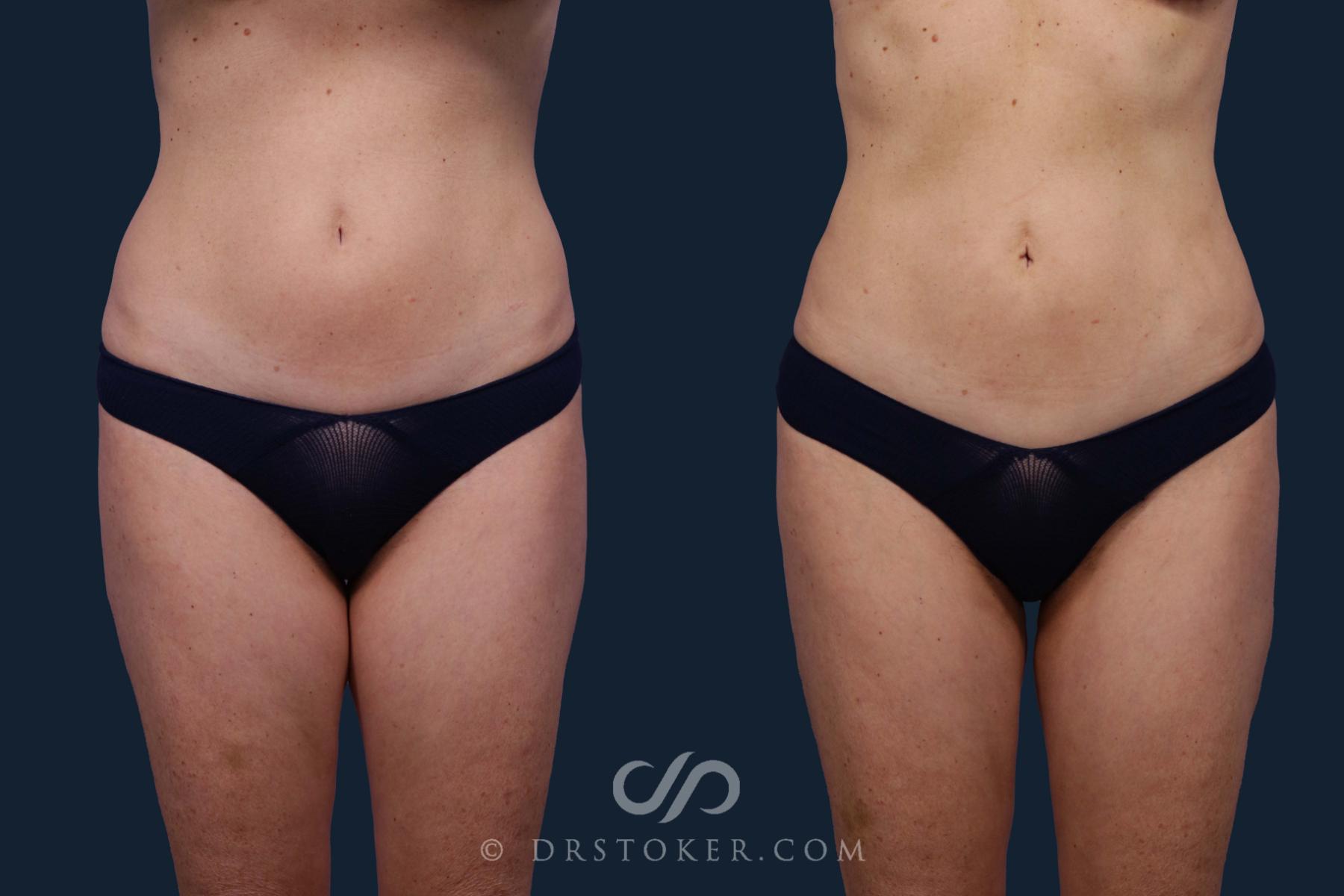 Before & After Liposuction Case 1966 Front View in Los Angeles, CA