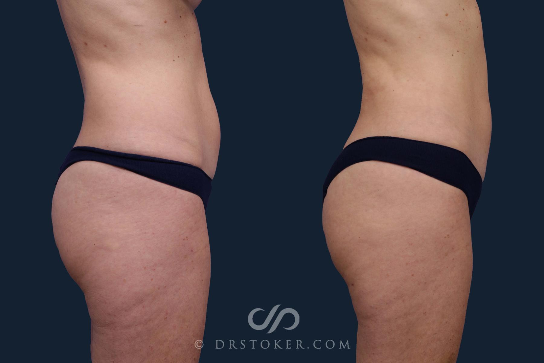 Before & After Liposuction Case 1967 Right Side View in Los Angeles, CA
