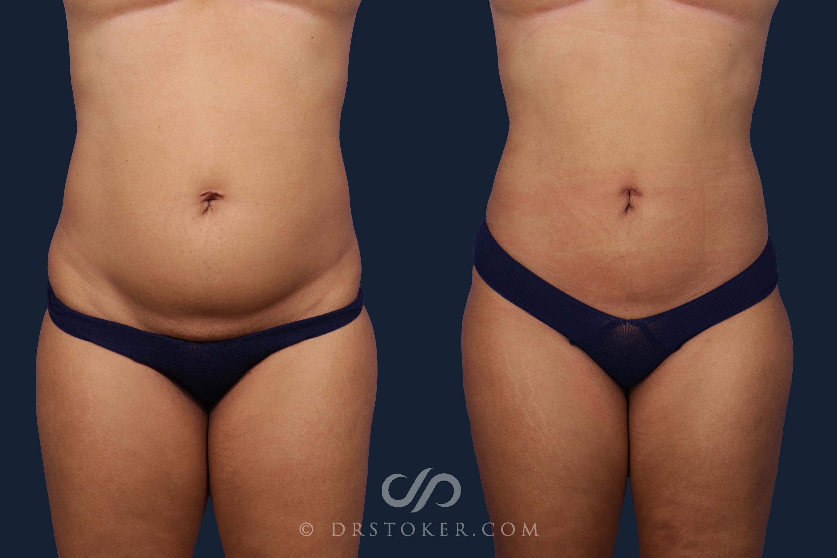 Before & After Liposuction Case 1968 Front View in Los Angeles, CA