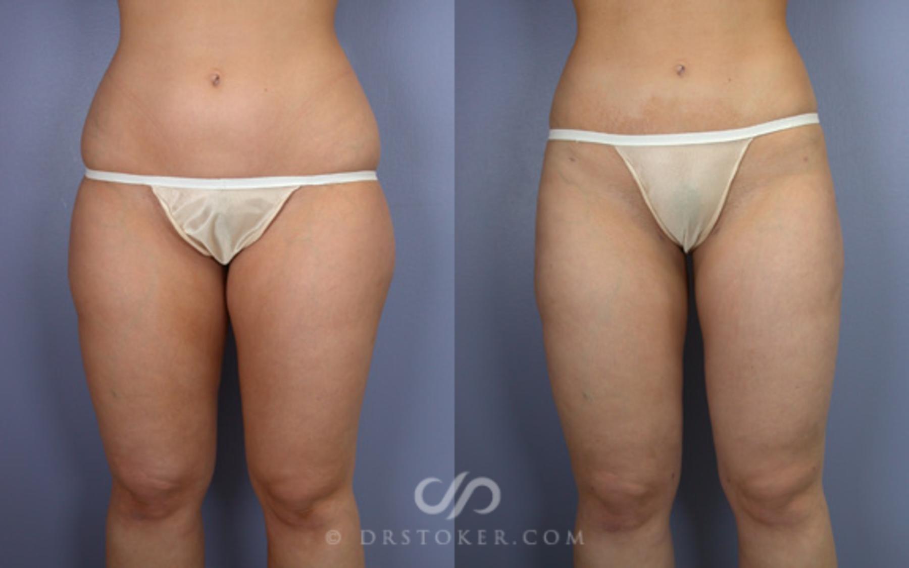 Before & After Liposuction Case 20 View #1 View in Los Angeles, CA