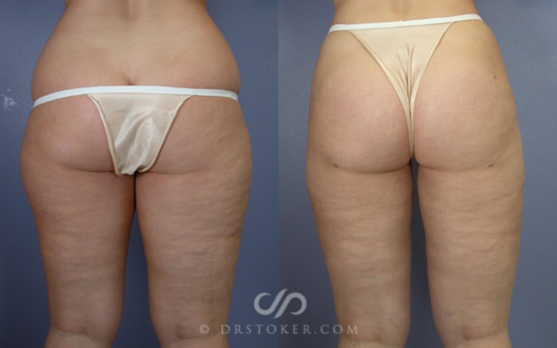 Before & After Liposuction Case 20 View #2 View in Los Angeles, CA