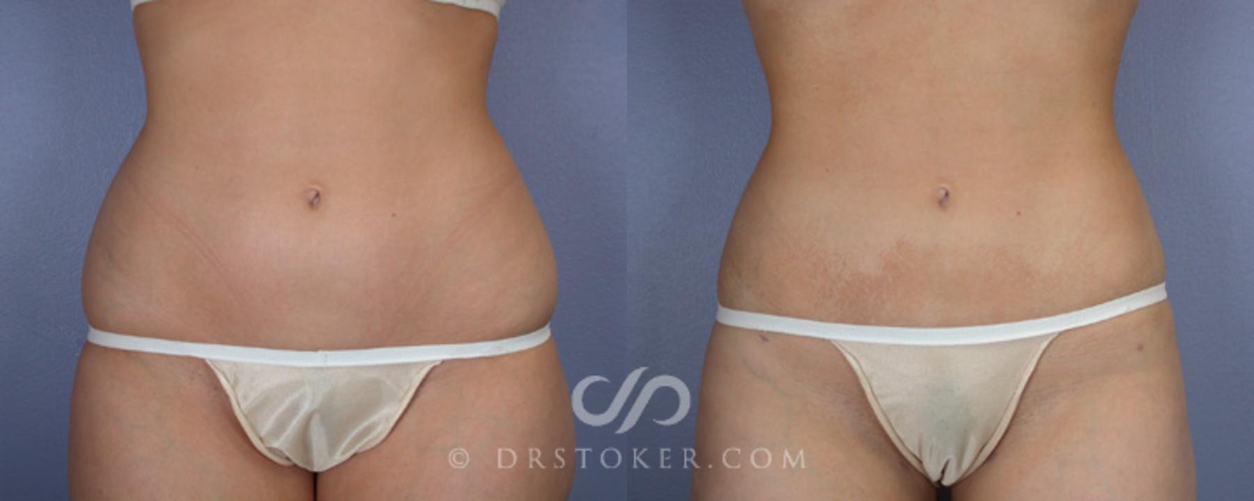 Before & After Liposuction Case 20 View #3 View in Los Angeles, CA