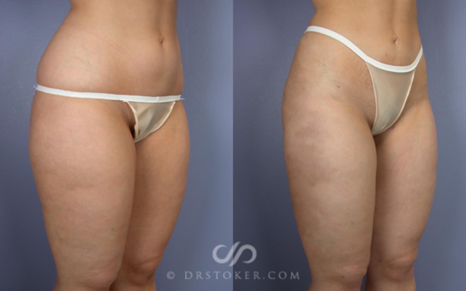 Before & After Liposuction Case 20 View #4 View in Los Angeles, CA