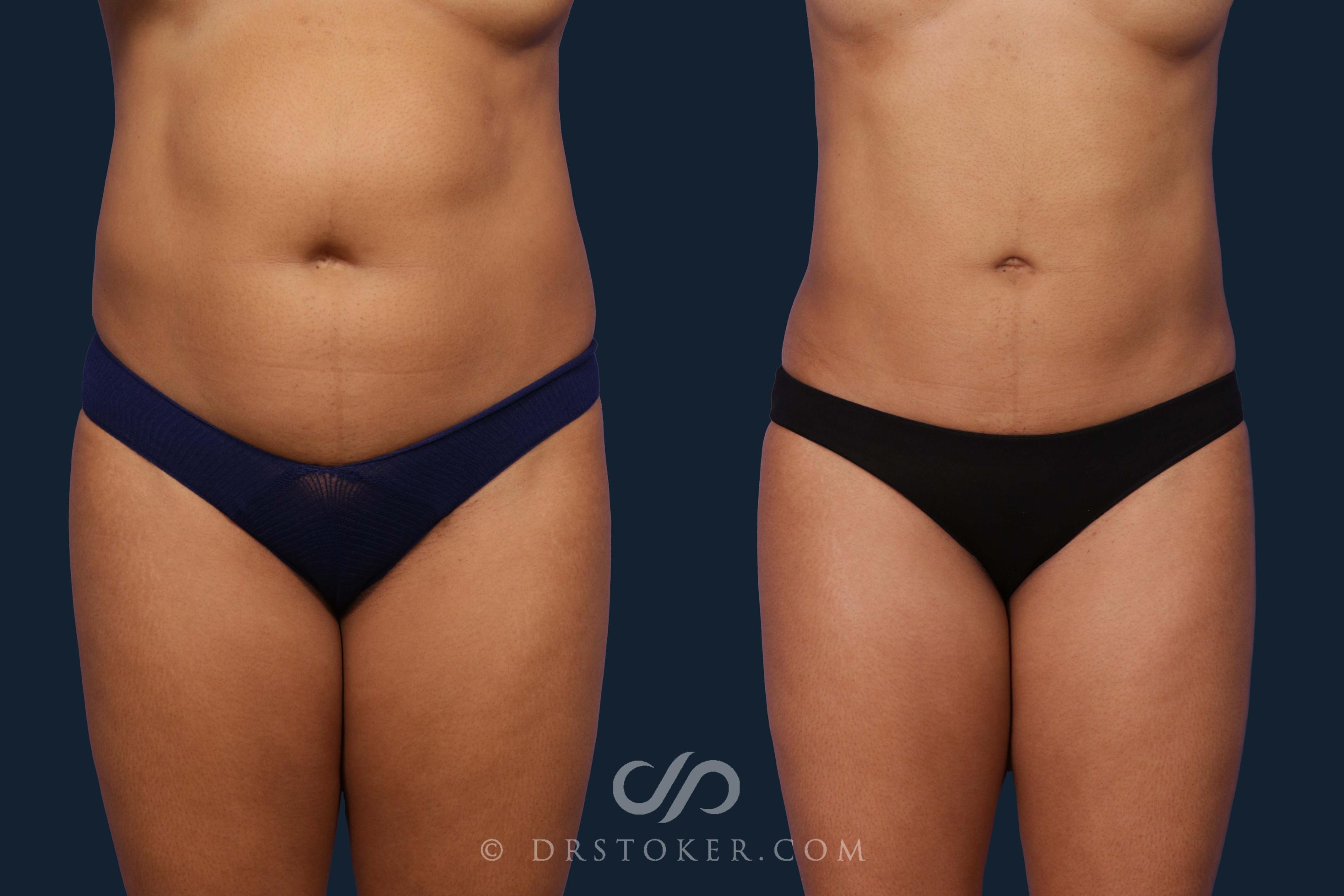 Before & After Liposuction Case 2013 Front View in Los Angeles, CA