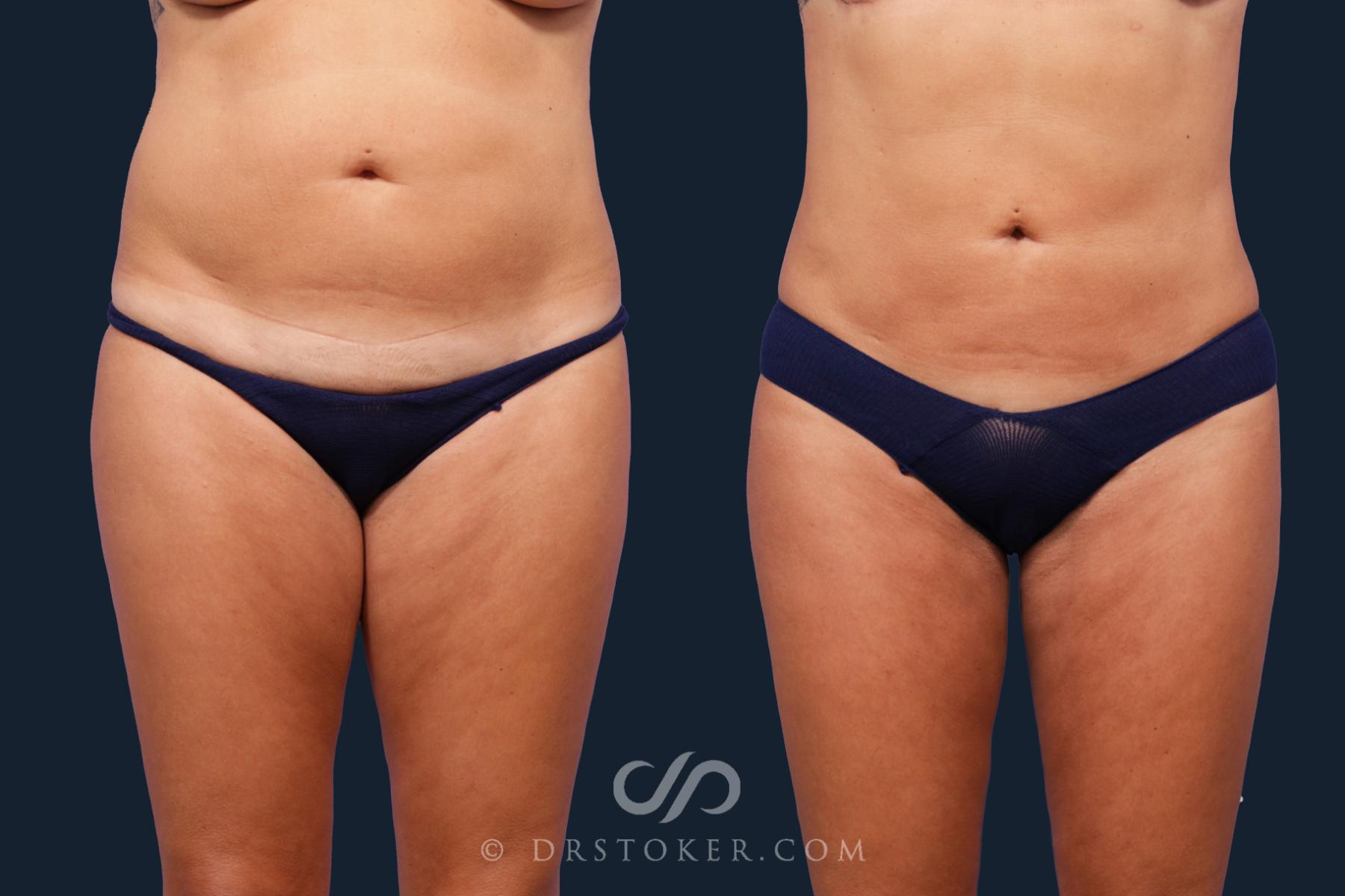 Before & After Liposuction Case 2022 Front View in Los Angeles, CA