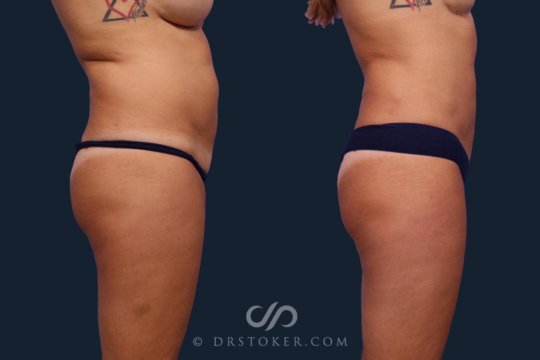 Before & After Liposuction Case 2022 Right Side View in Los Angeles, CA