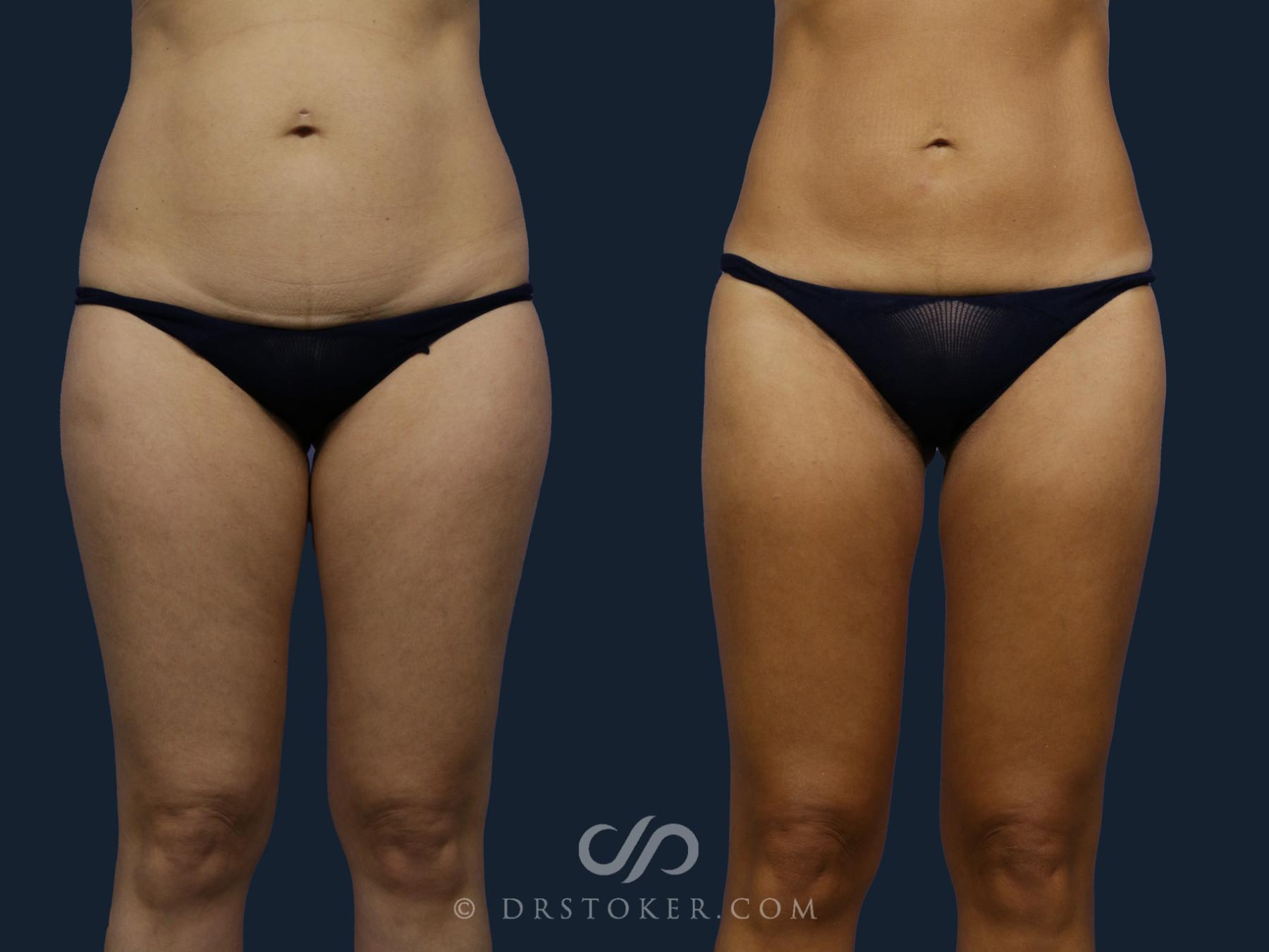 Before & After Liposuction Case 2049 Front View in Los Angeles, CA