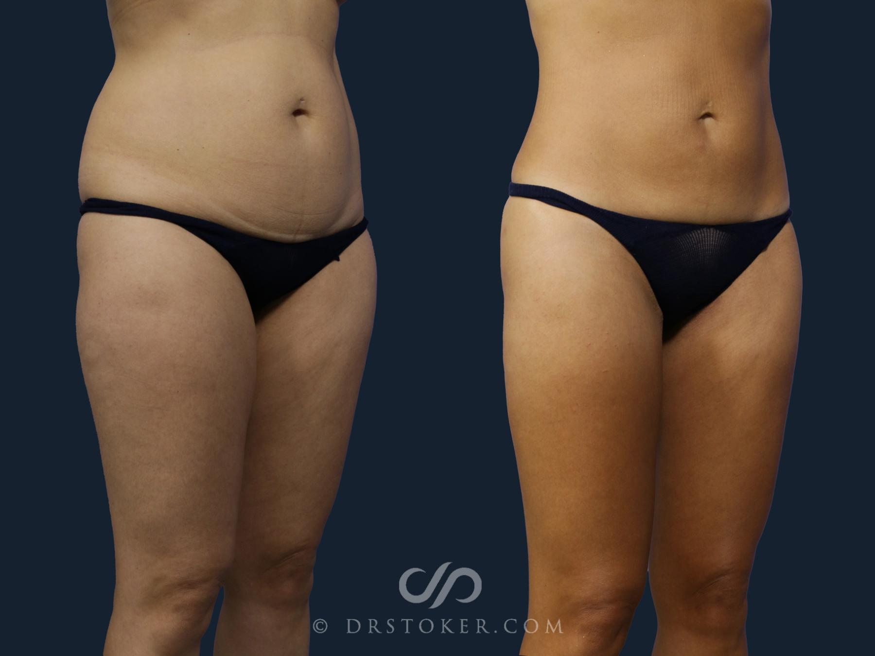 Before & After Liposuction Case 2049 Right Oblique View in Los Angeles, CA