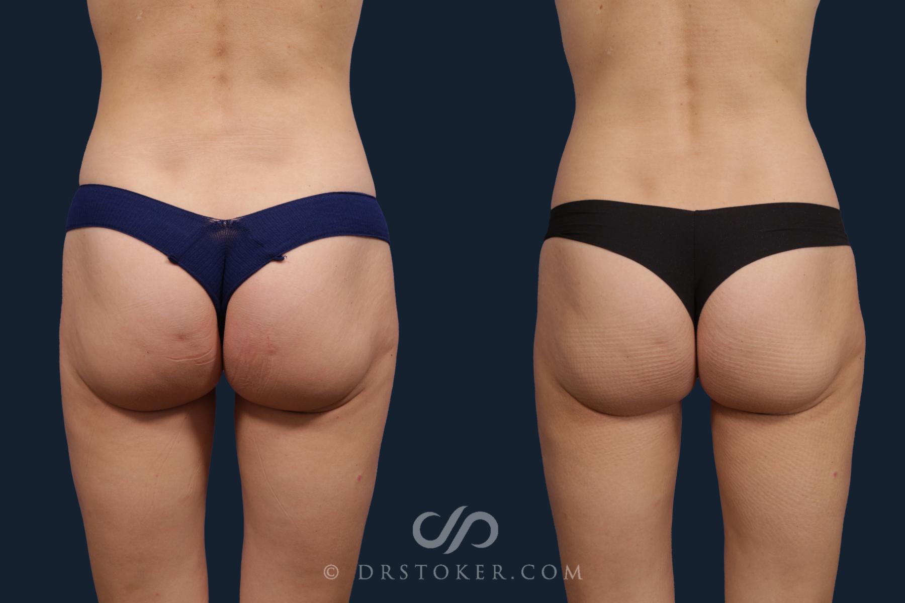 Before & After Liposuction Case 2055 Back View in Los Angeles, CA