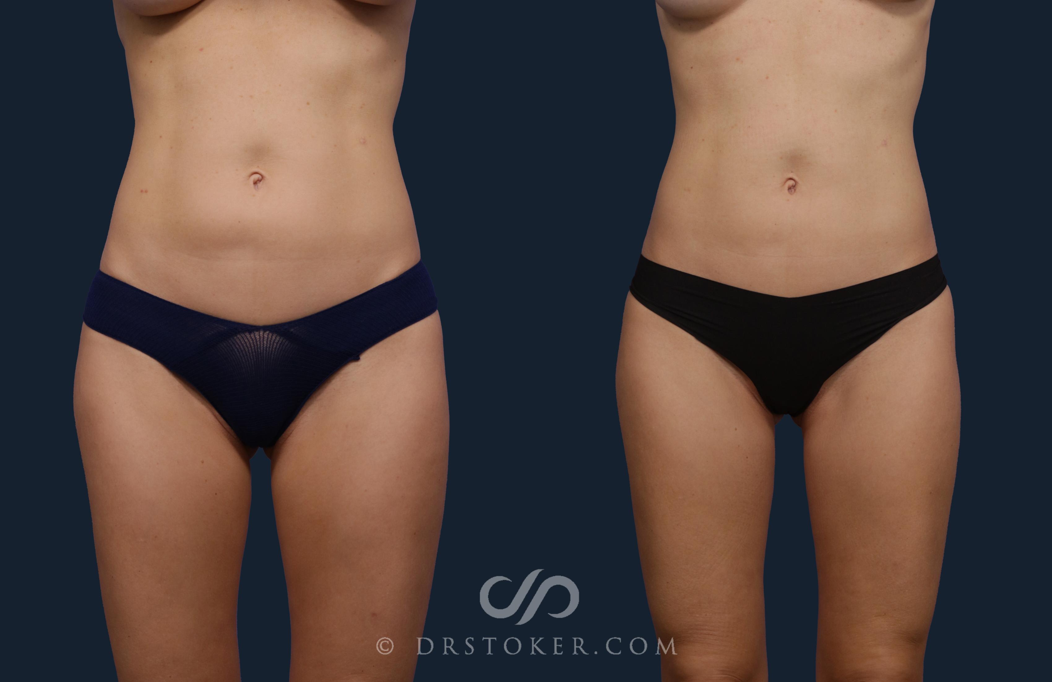 Before & After Liposuction Case 2055 Front View in Los Angeles, CA