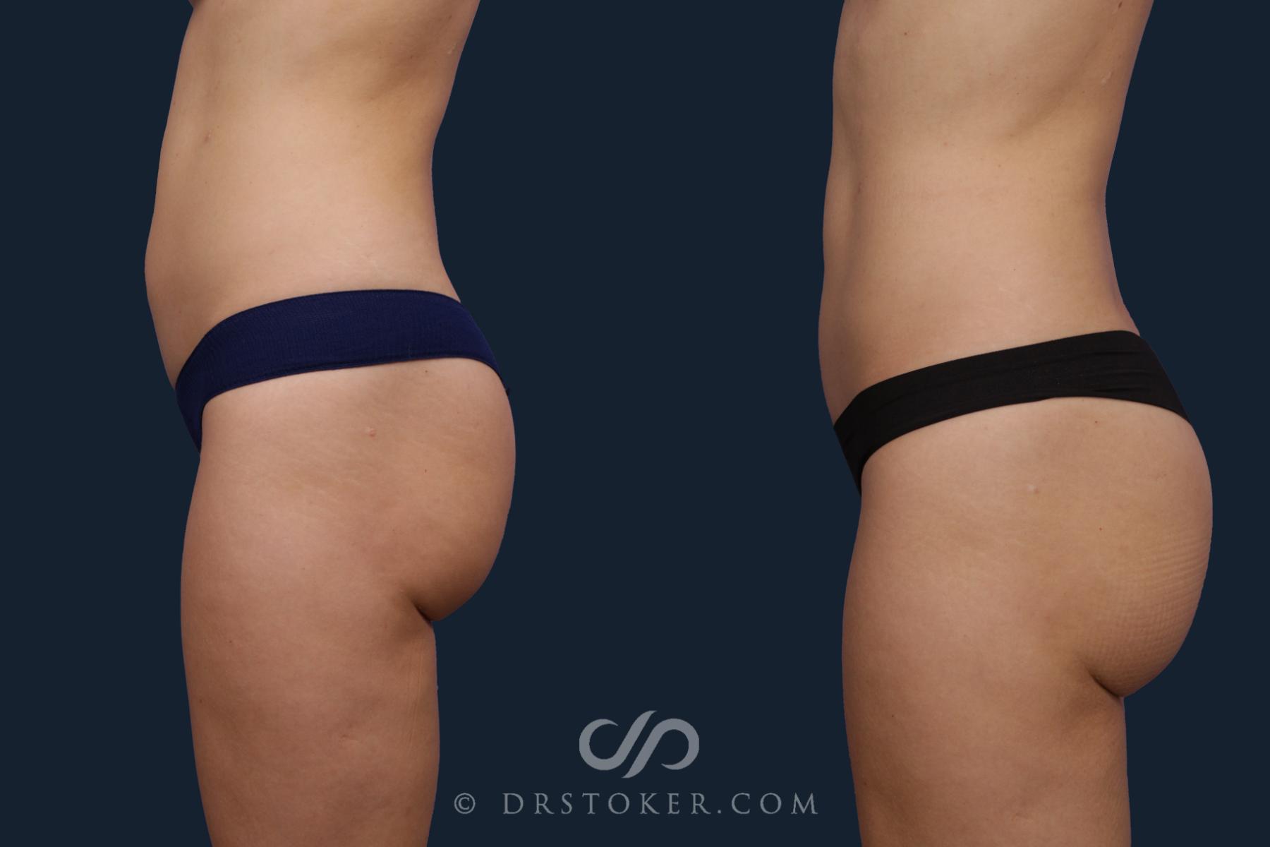 Before & After Liposuction Case 2055 Left Side View in Los Angeles, CA