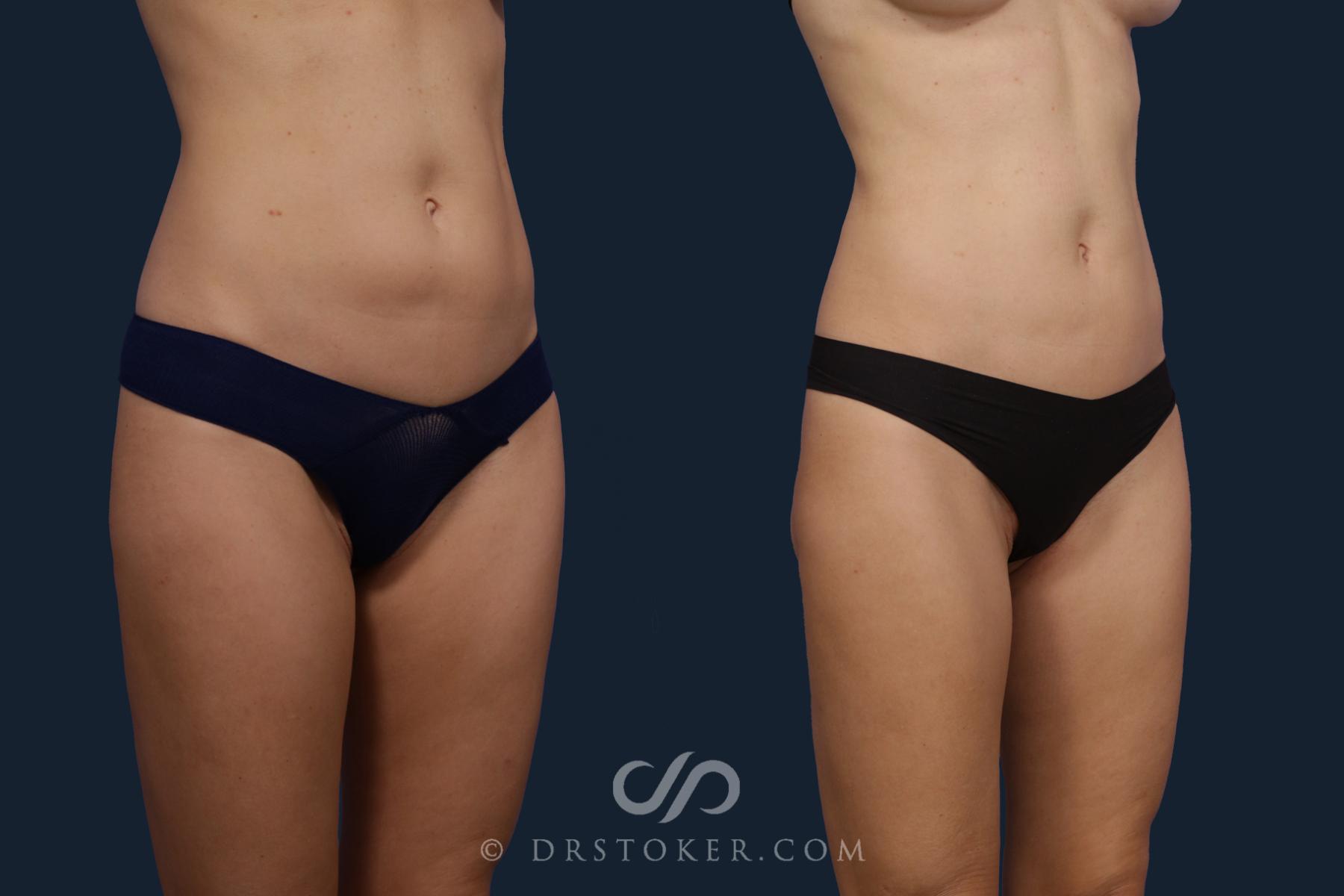 Before & After Liposuction Case 2055 Right Oblique View in Los Angeles, CA