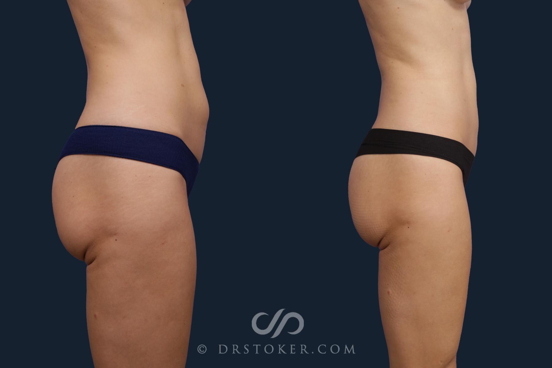 Before & After Liposuction Case 2055 Right Side View in Los Angeles, CA