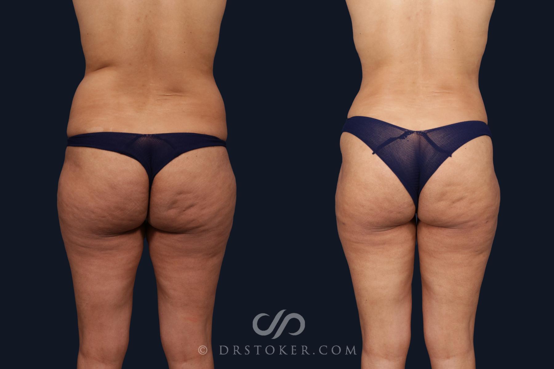 Before & After Liposuction Case 2064 Back View in Los Angeles, CA