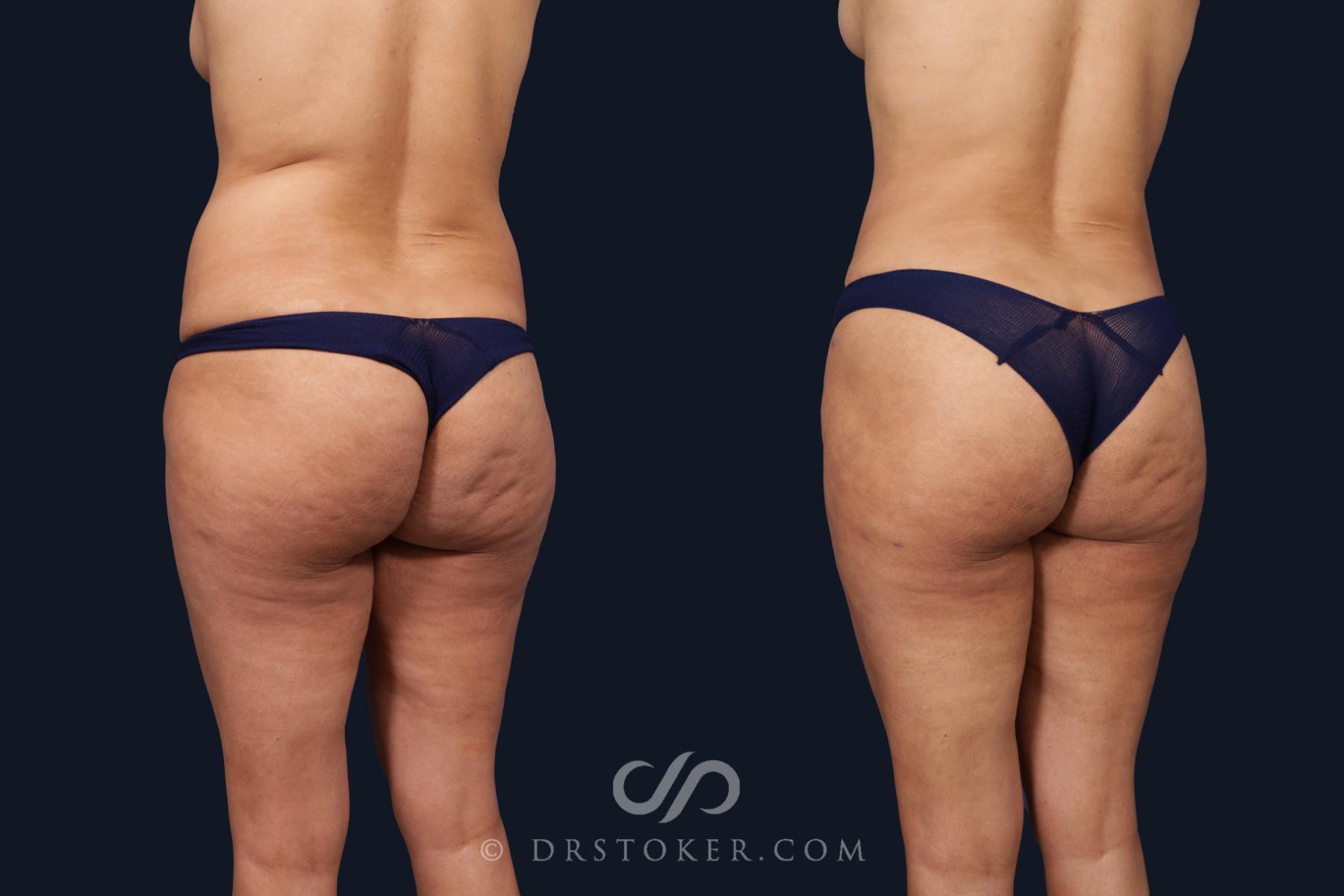 Before & After Liposuction Case 2064 Left Oblique View in Los Angeles, CA