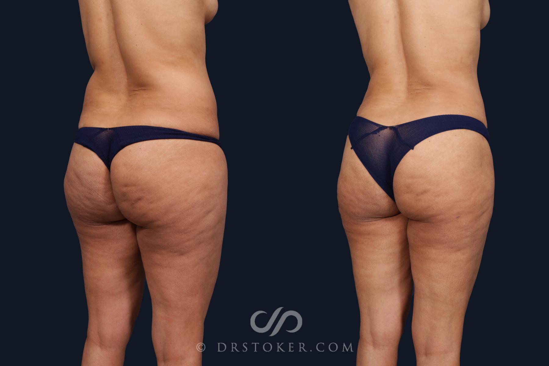 Before & After Liposuction Case 2064 Right Oblique View in Los Angeles, CA
