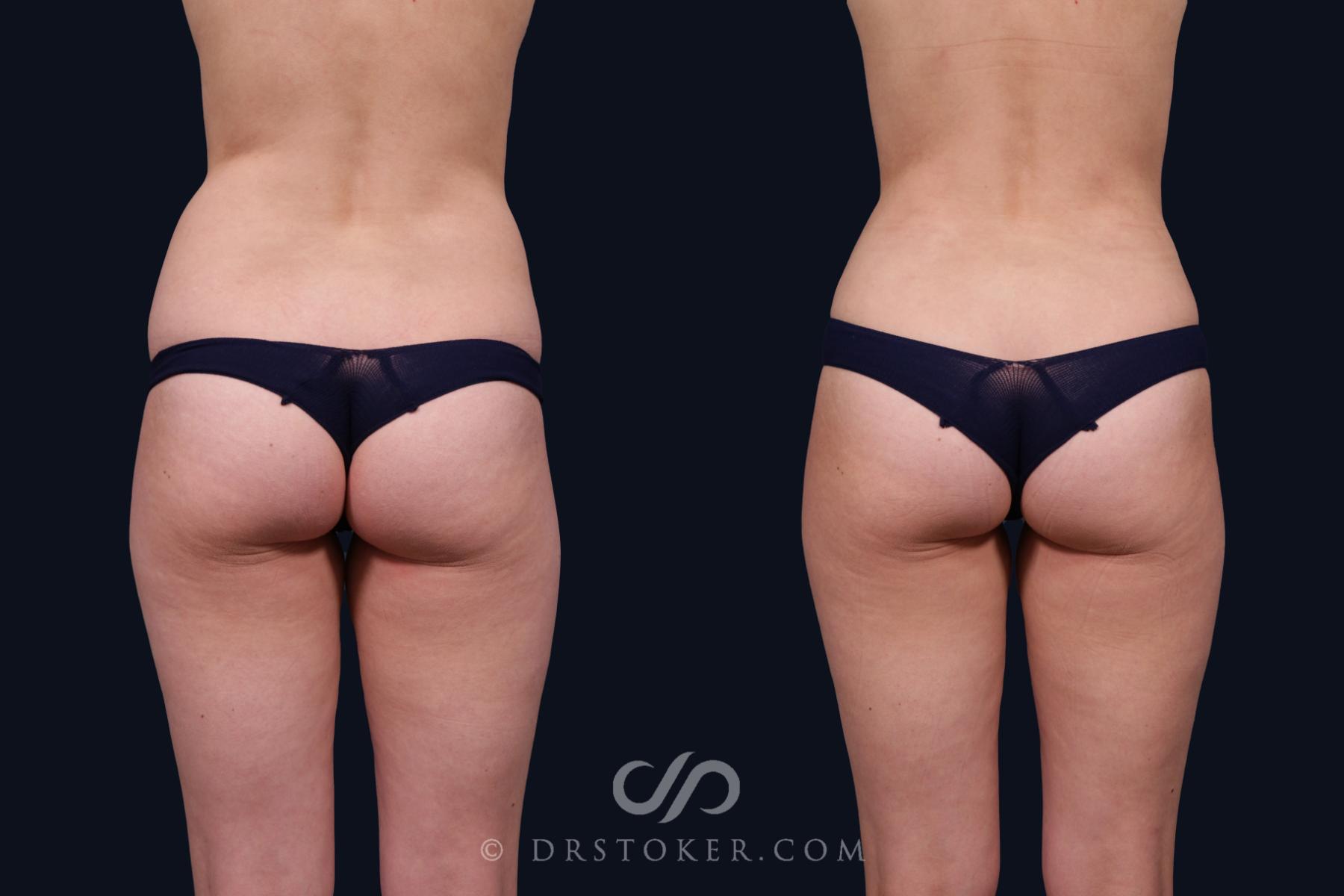 Before & After Liposuction Case 2070 Back View in Los Angeles, CA