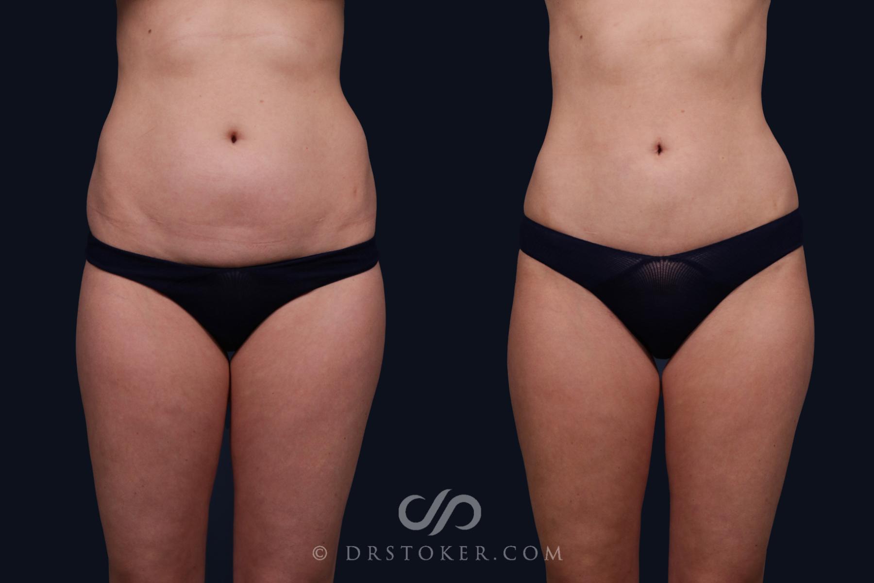 Before & After Liposuction Case 2070 Front View in Los Angeles, CA