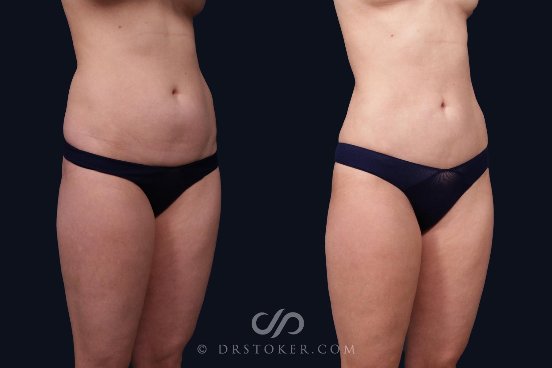 Before & After Liposuction Case 2070 Right Oblique View in Los Angeles, CA