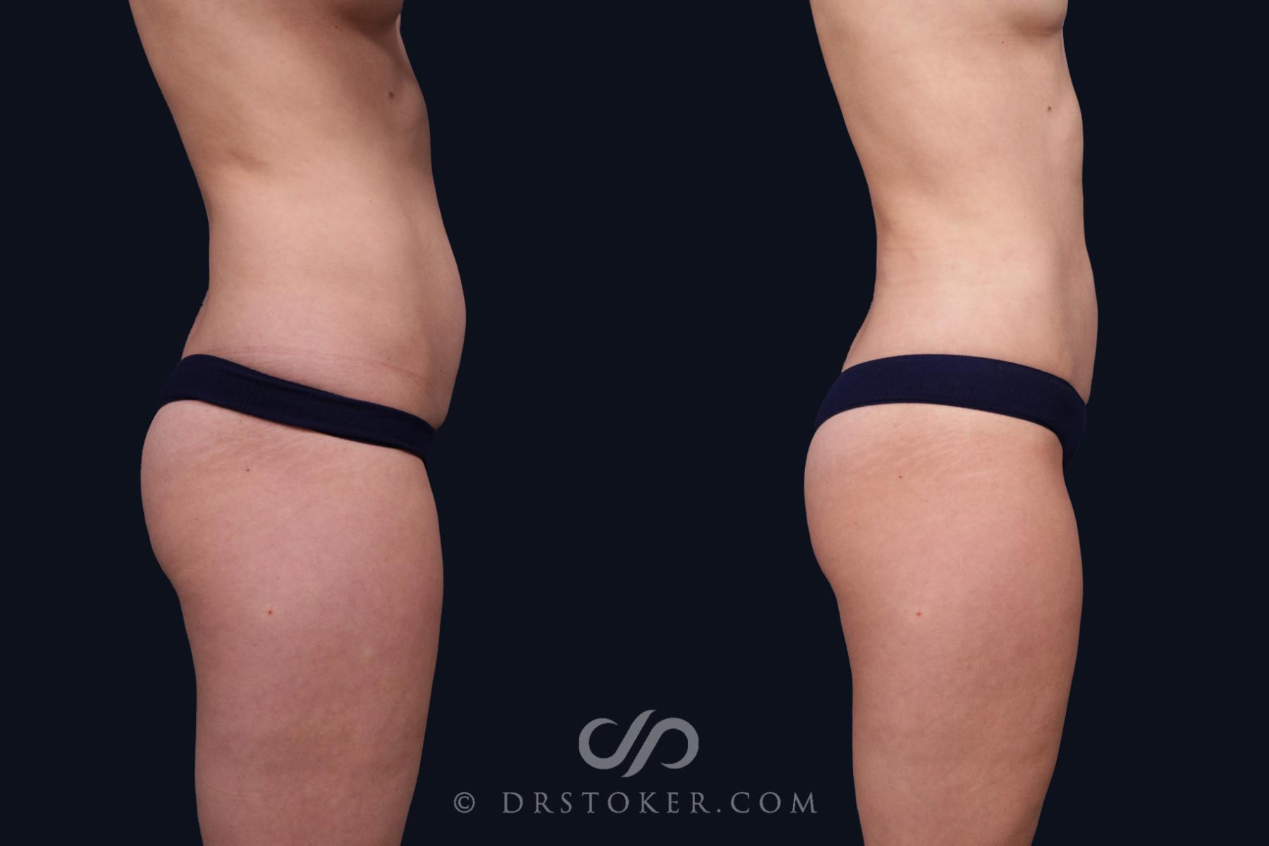 Before & After Liposuction Case 2070 Right Side View in Los Angeles, CA