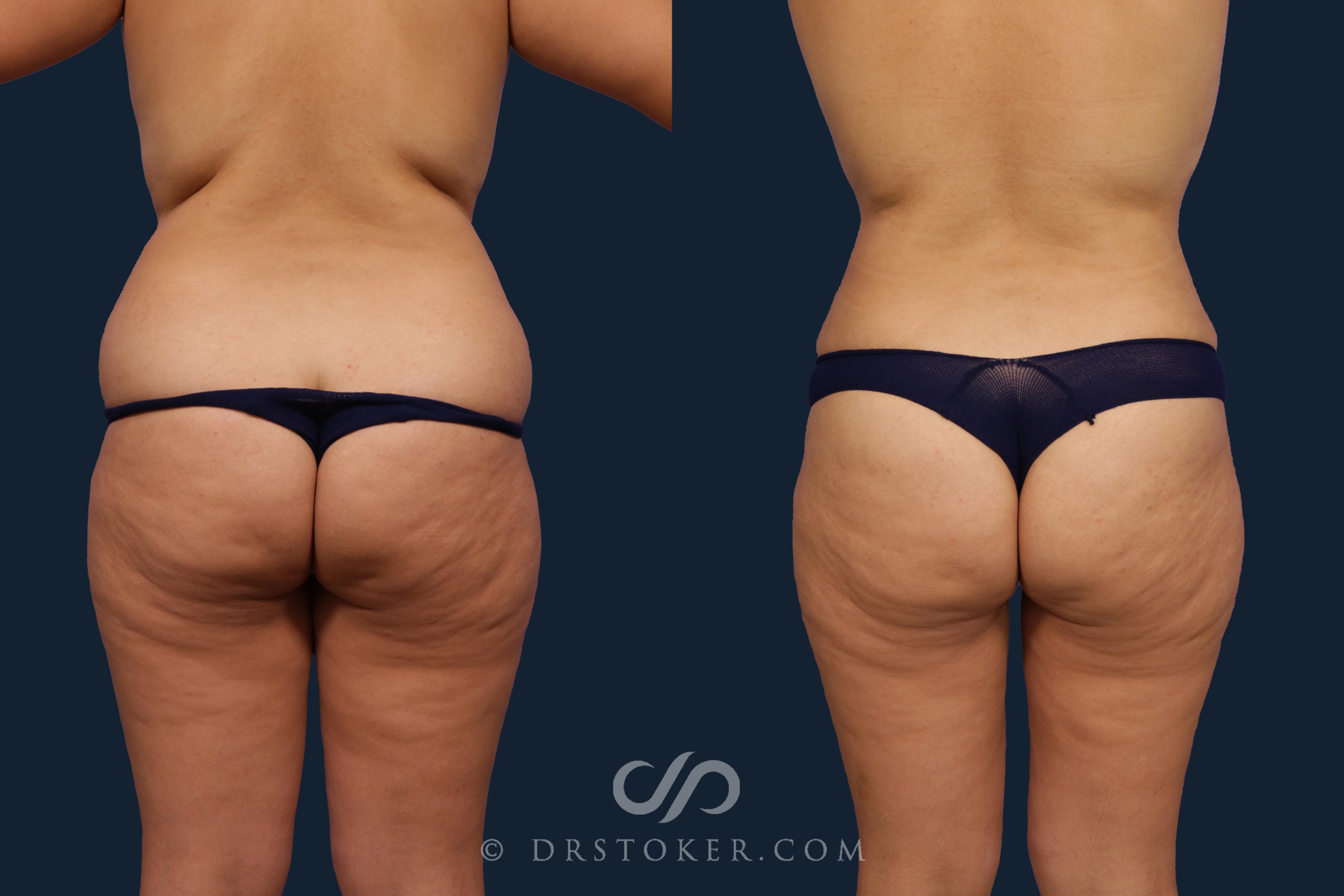 Before & After Liposuction Case 2079 Back View in Los Angeles, CA