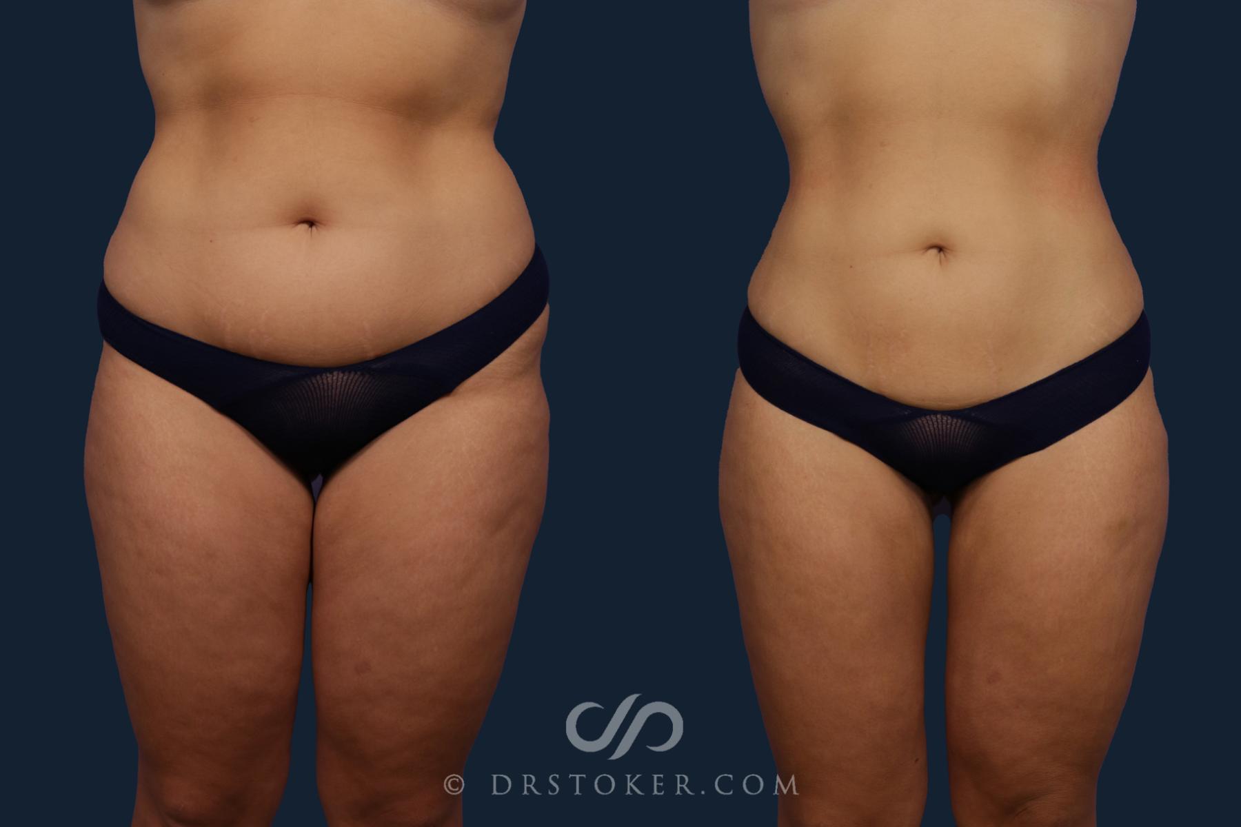 Before & After Liposuction Case 2079 Front View in Los Angeles, CA