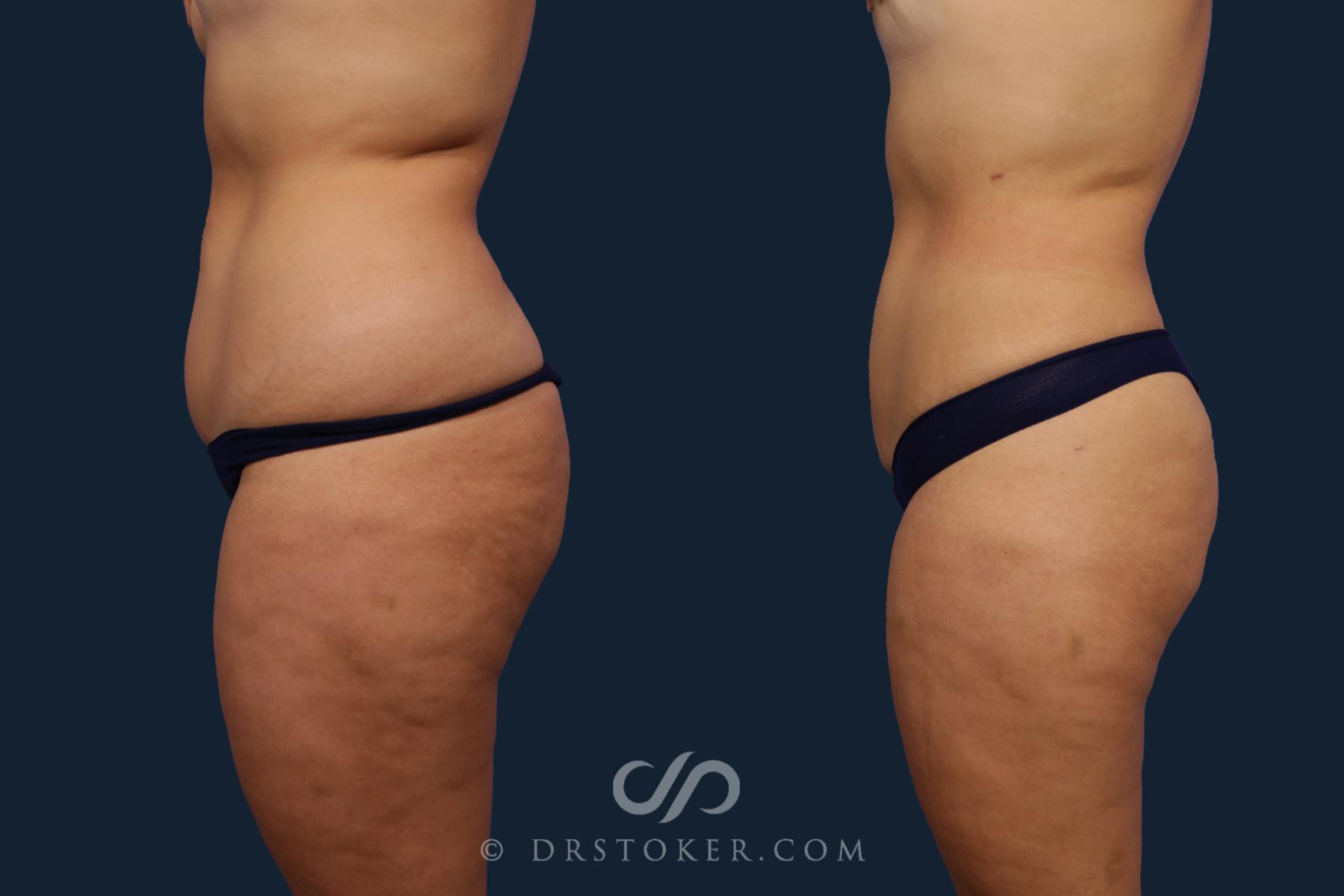 Before & After Liposuction Case 2079 Left Side View in Los Angeles, CA
