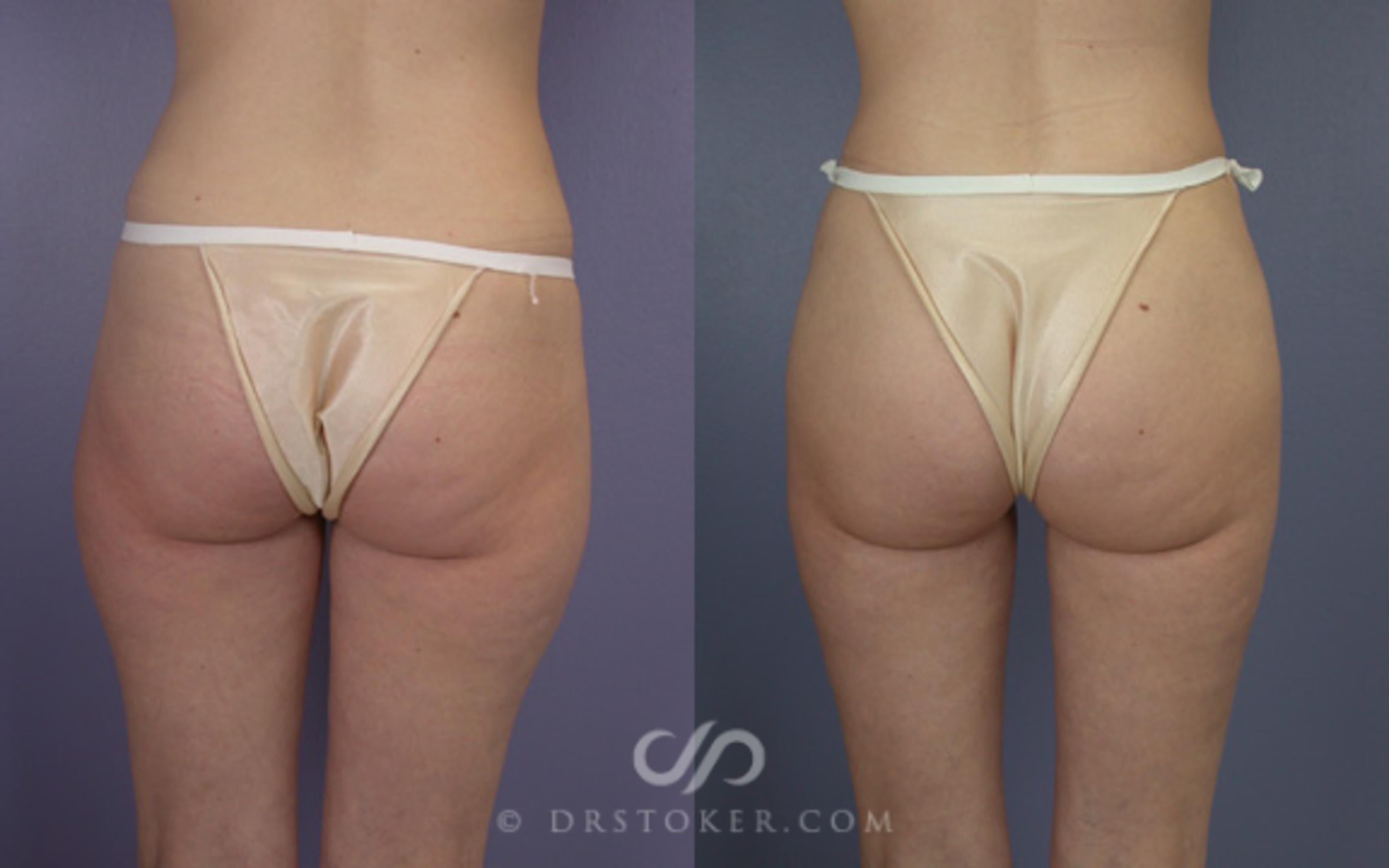 Before & After Liposuction Case 21 View #1 View in Los Angeles, CA