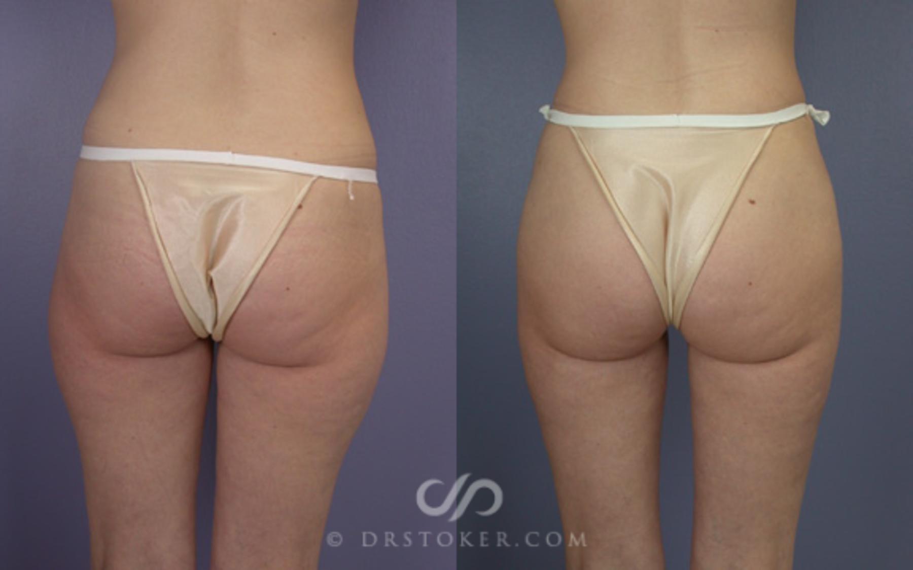 Before & After Liposuction Case 21 View #1 View in Los Angeles, CA