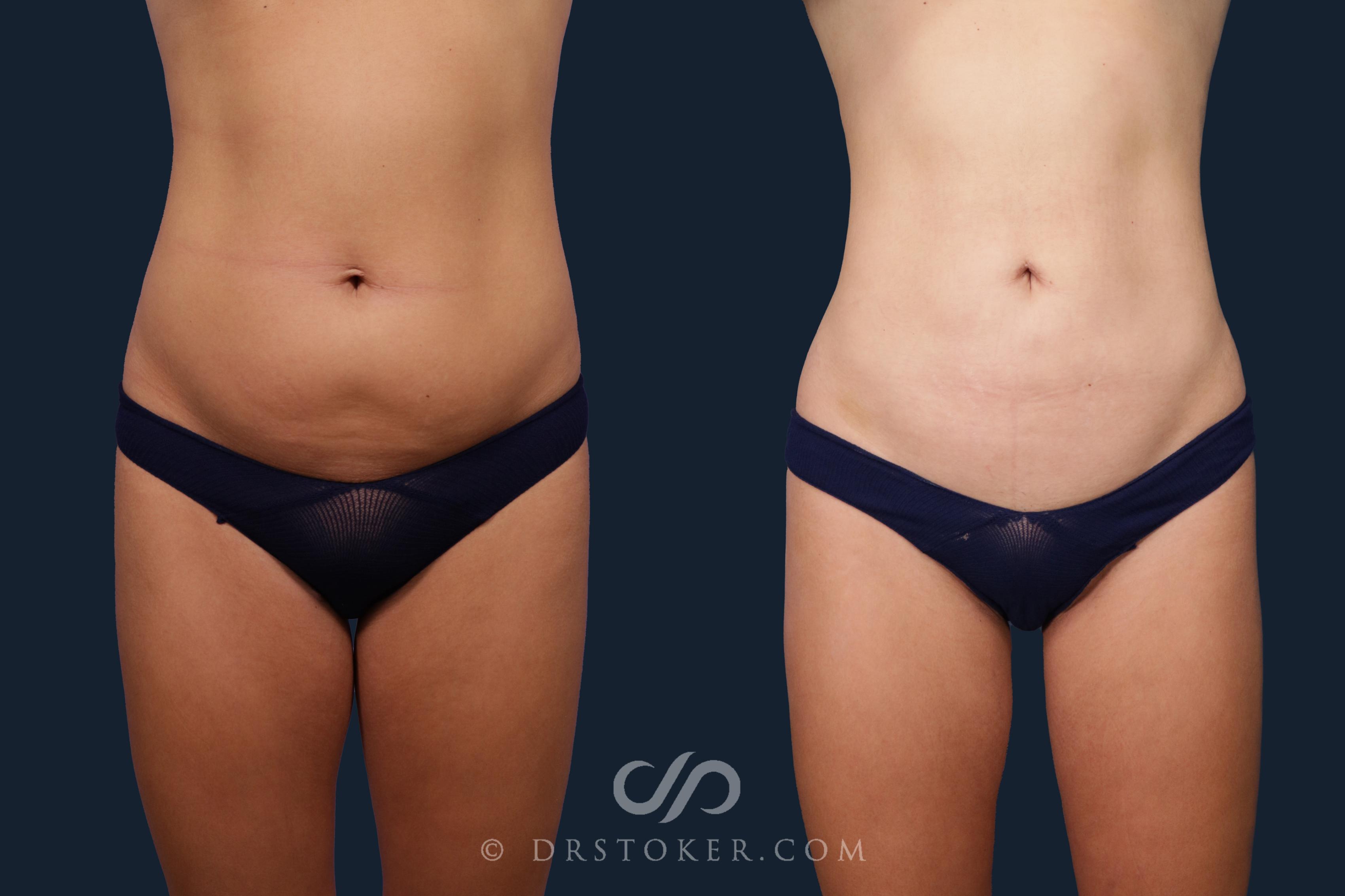 Before & After Liposuction Case 2137 Front View in Los Angeles, CA