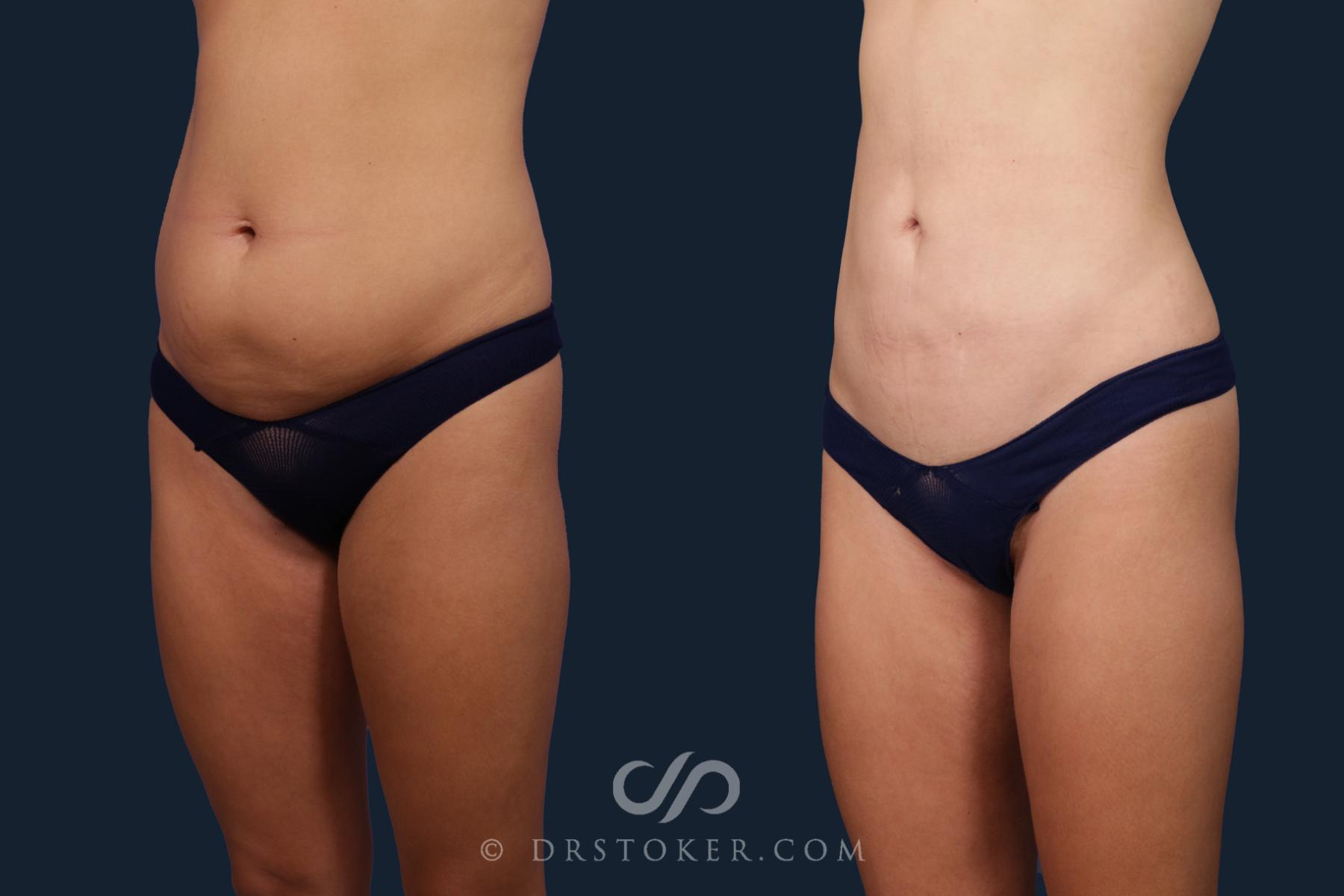 Before & After Liposuction Case 2137 Left Oblique View in Los Angeles, CA