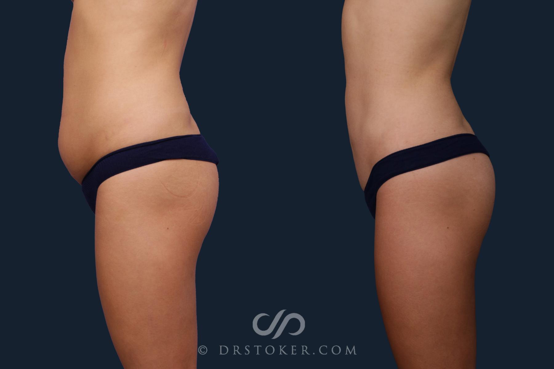 Before & After Liposuction Case 2137 Left Side View in Los Angeles, CA