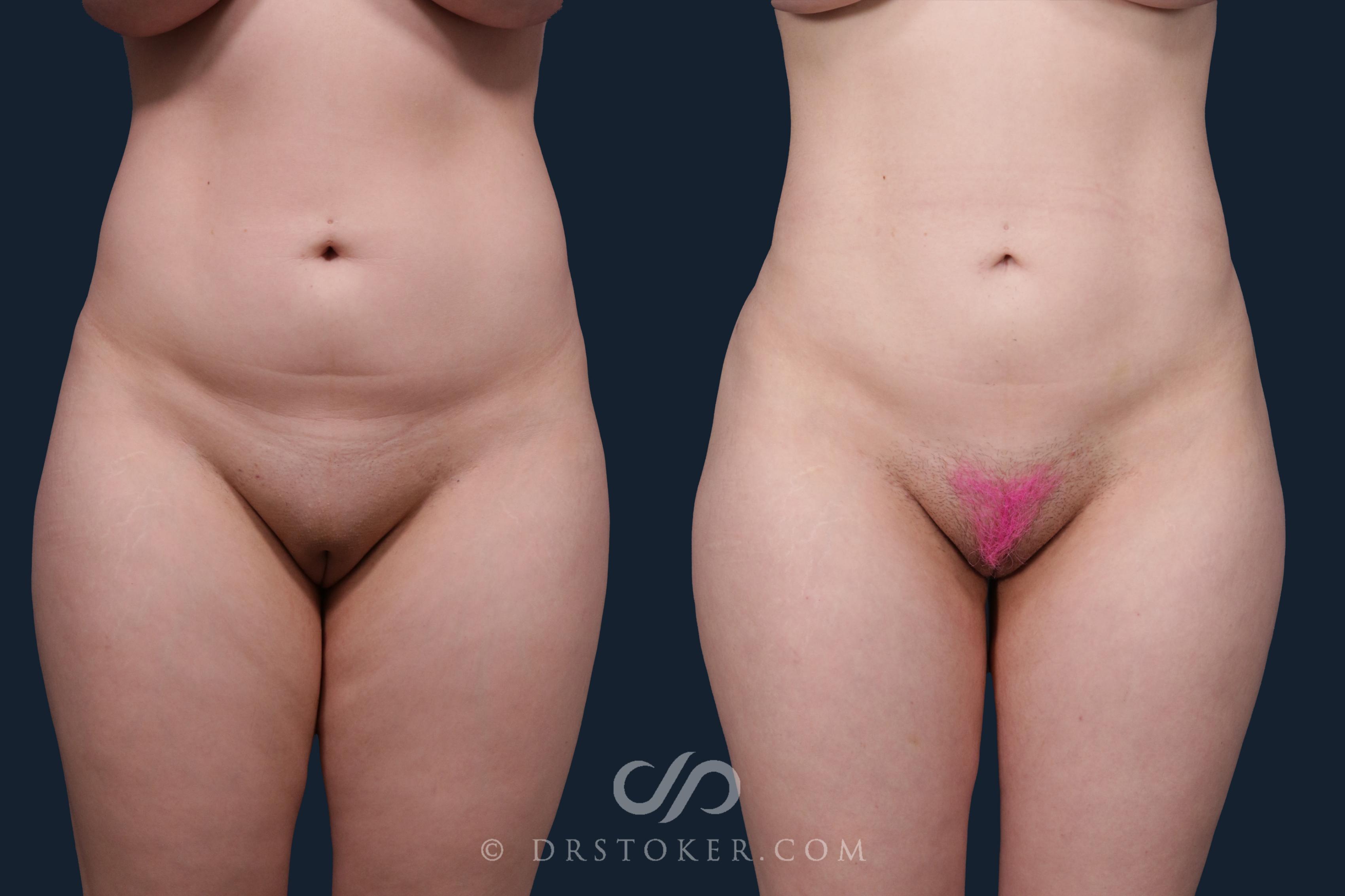 Before & After Liposuction Case 2171 Front View in Los Angeles, CA