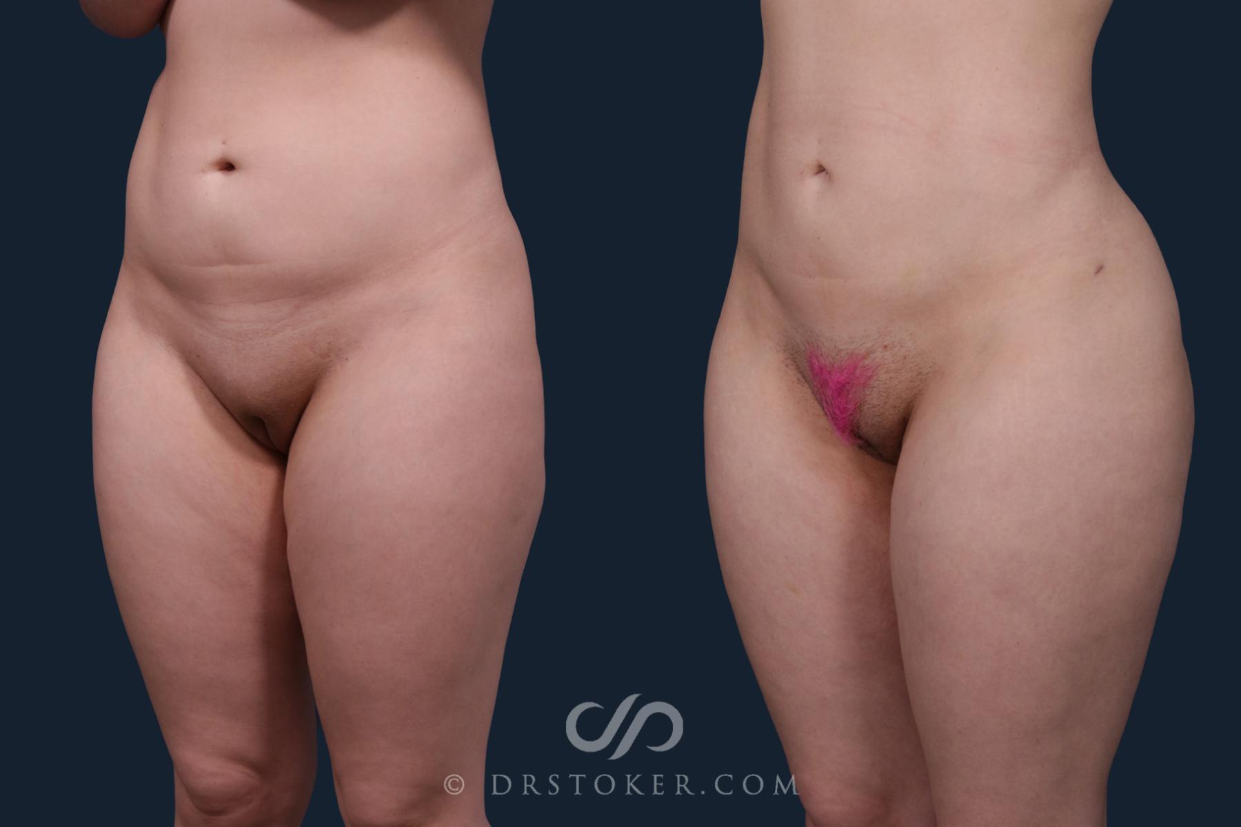 Before & After Liposuction Case 2171 Left Oblique View in Los Angeles, CA