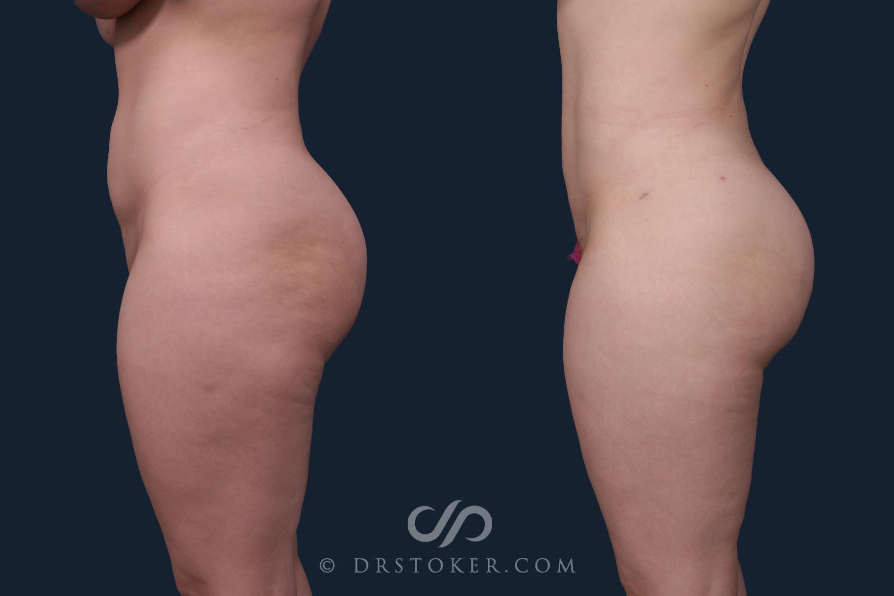 Before & After Liposuction Case 2171 Left Side View in Los Angeles, CA
