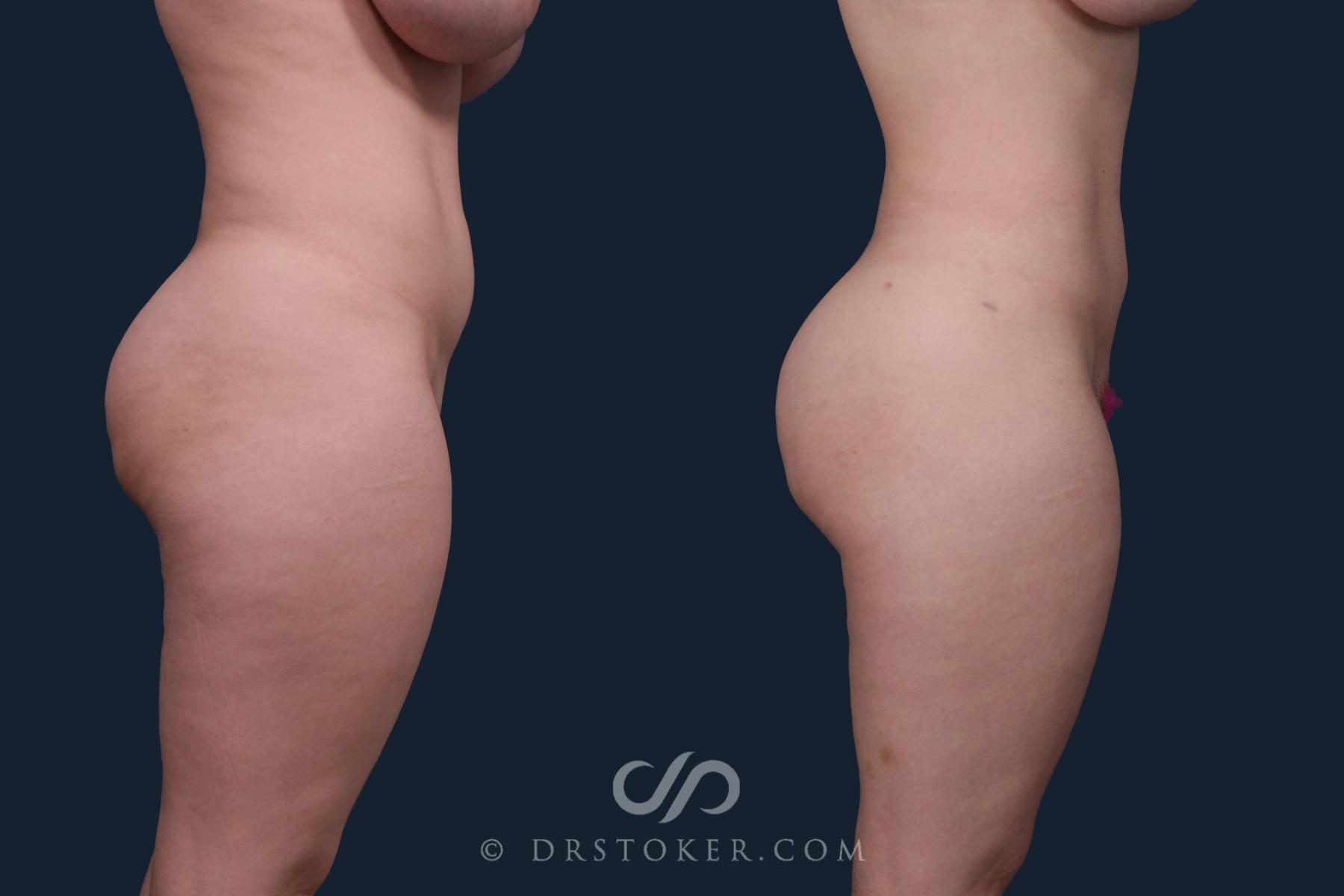 Before & After Liposuction Case 2171 Right Side View in Los Angeles, CA